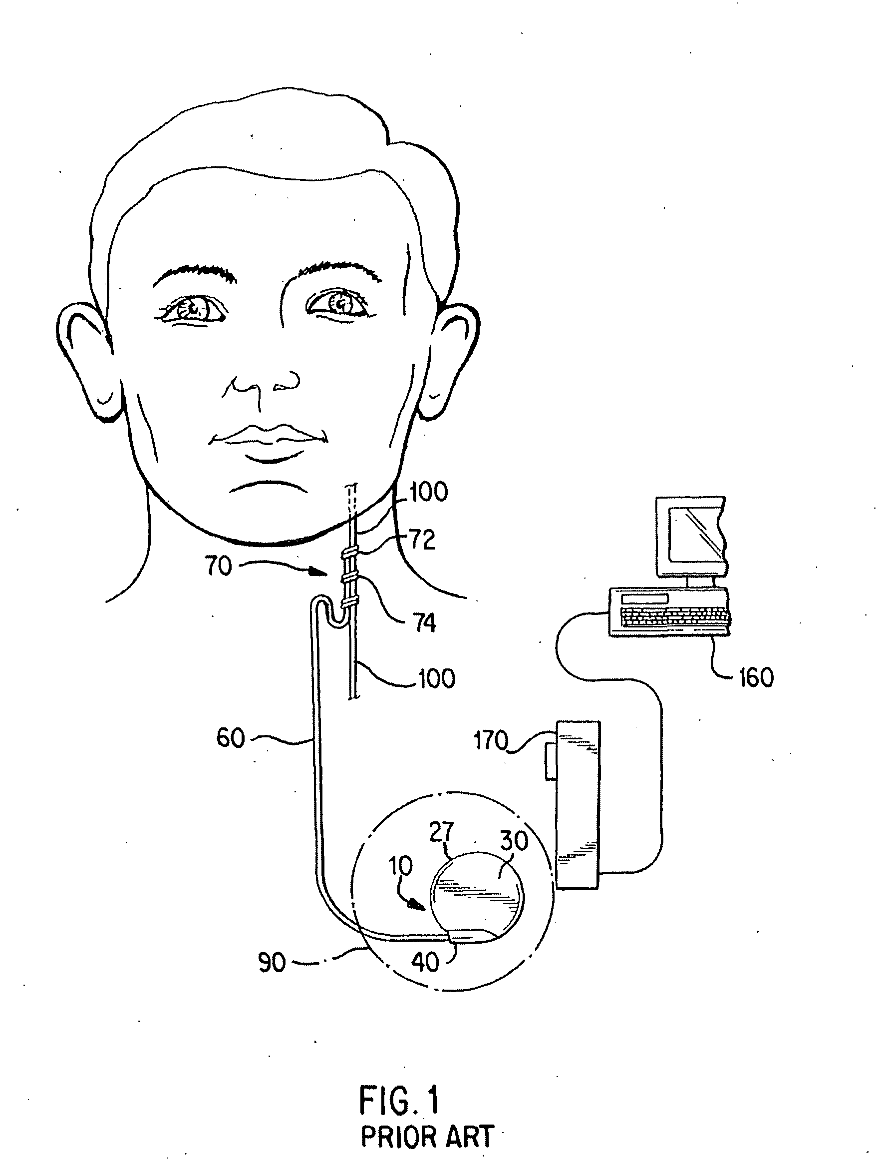 Neurostimulator with activation based on changes in body temperature