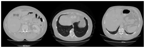 A Liver CT Atlas Segmentation Method and System Based on High Precision Registration