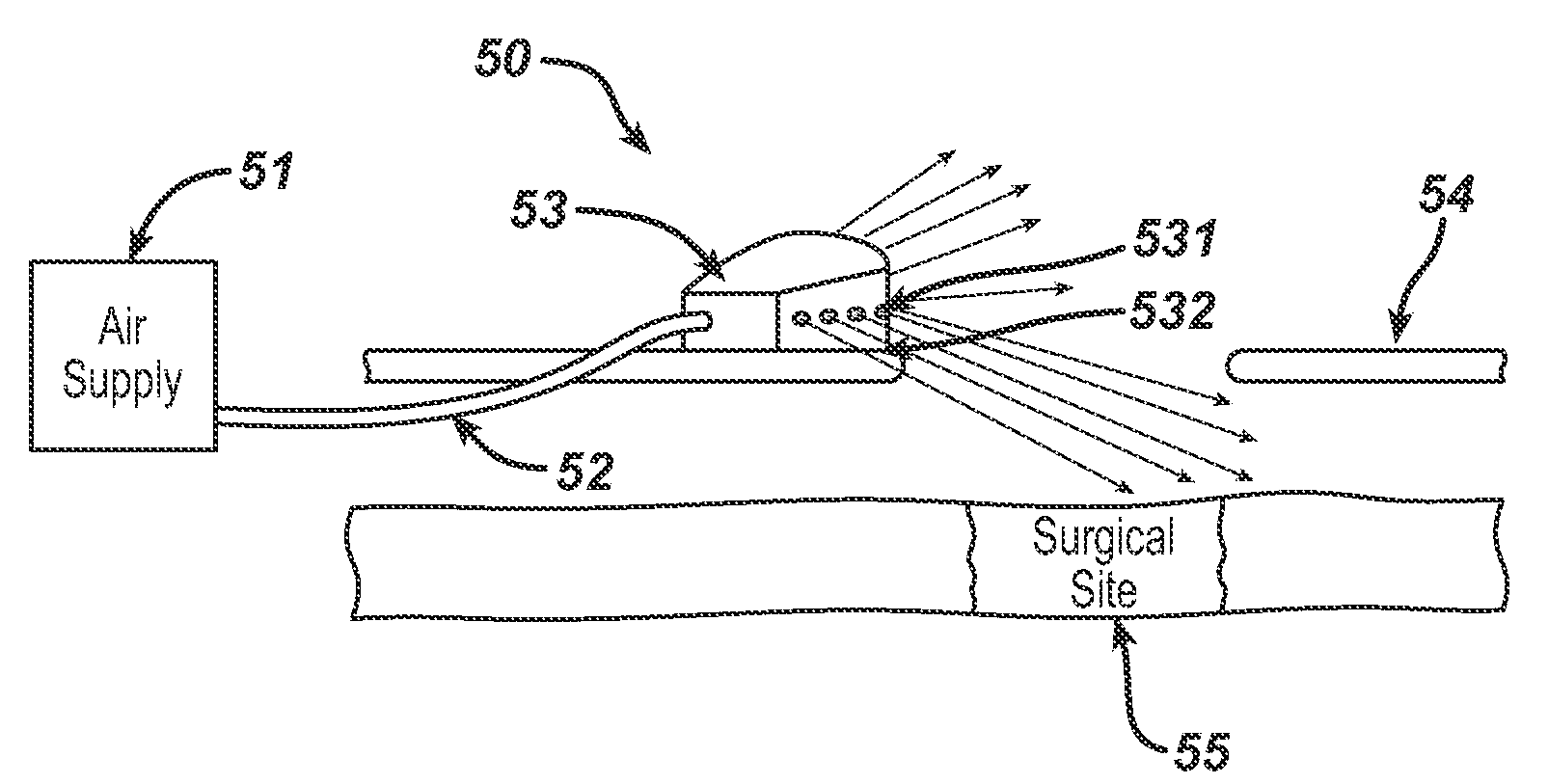 System and method for reducing surgical site infection