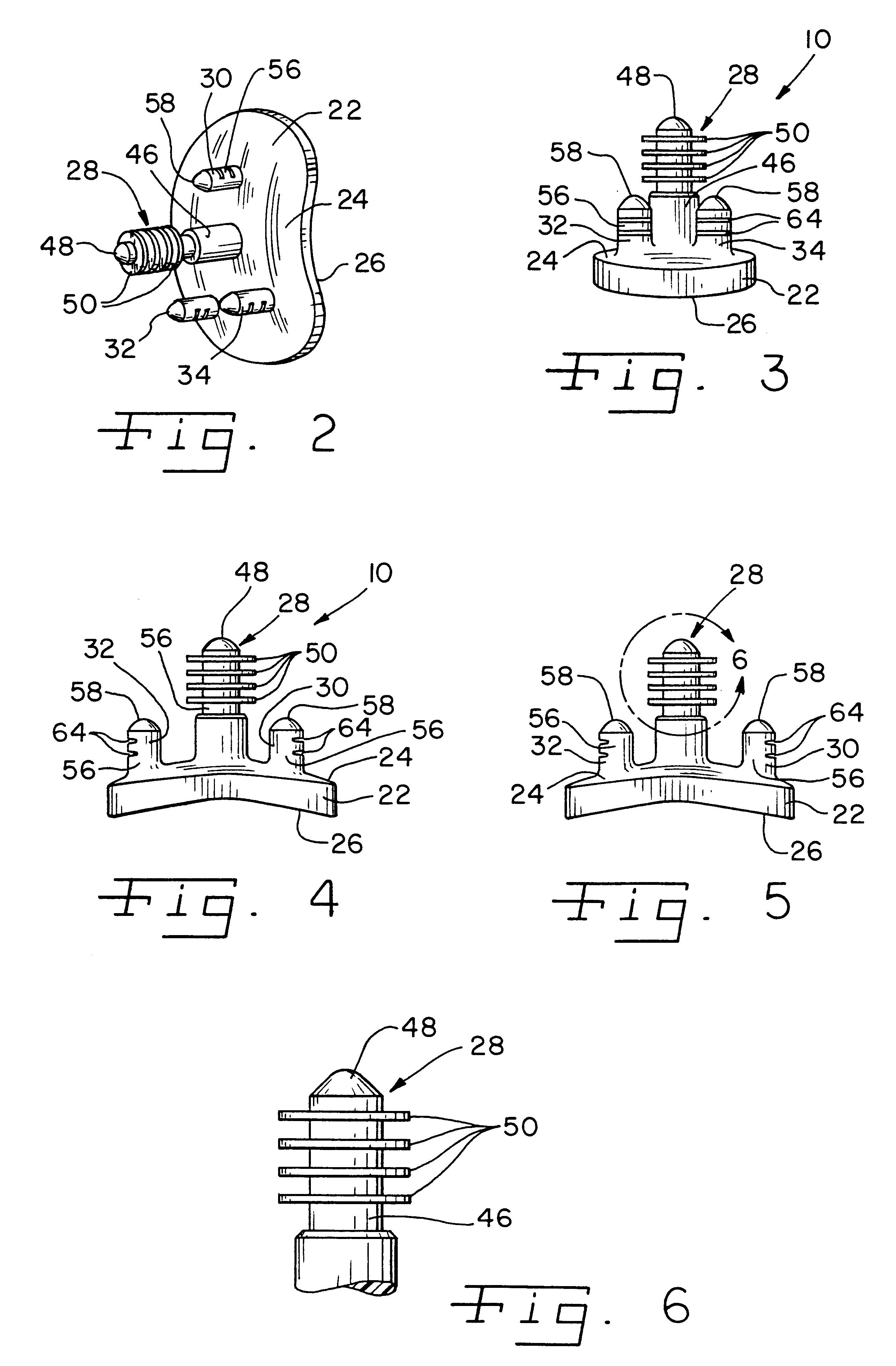 Apparatus and method for securing a cementless glenoid component to a glenoid surface of a scapula