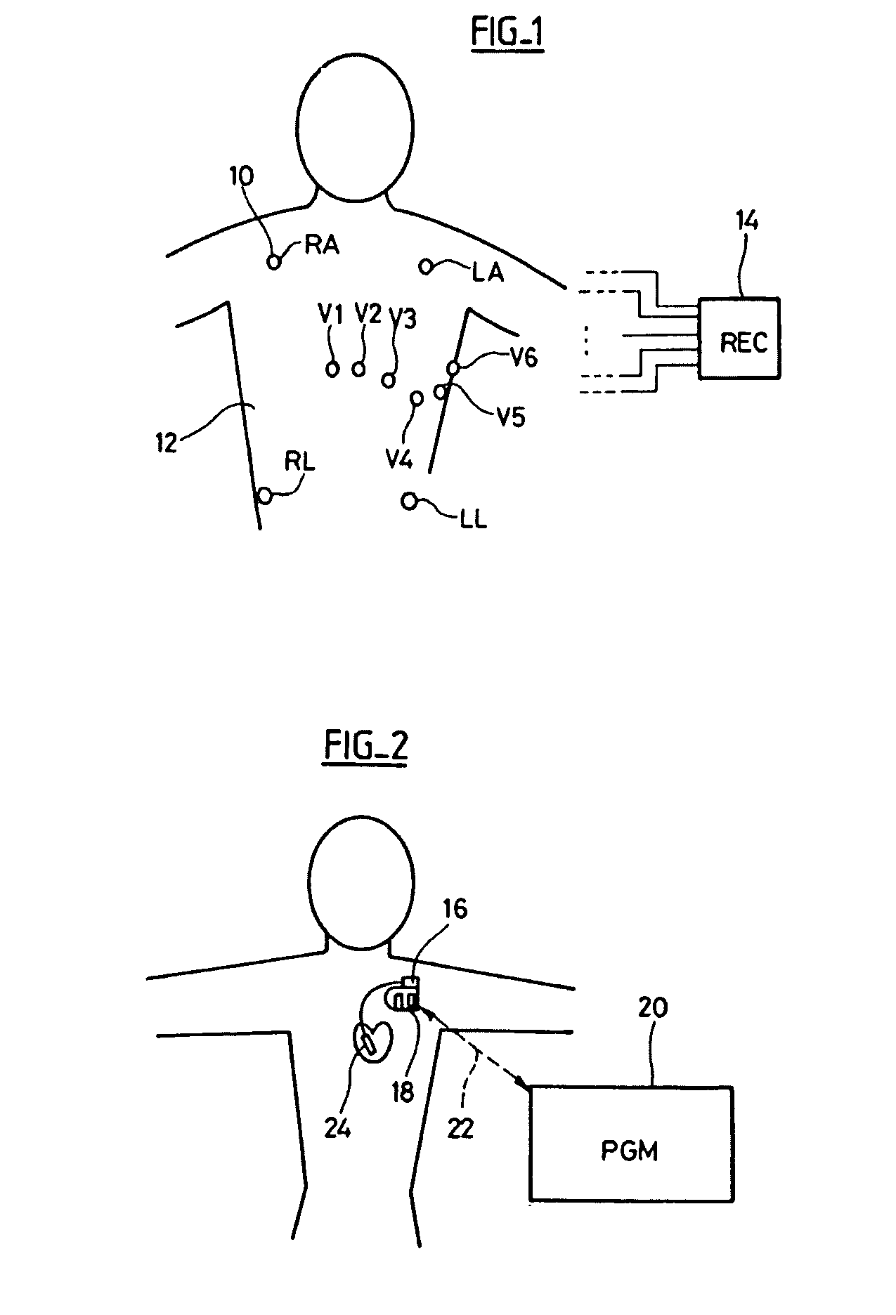 Electrocardiologic device for the assisted diagnosis of brugada syndrome or early repolarization syndrome