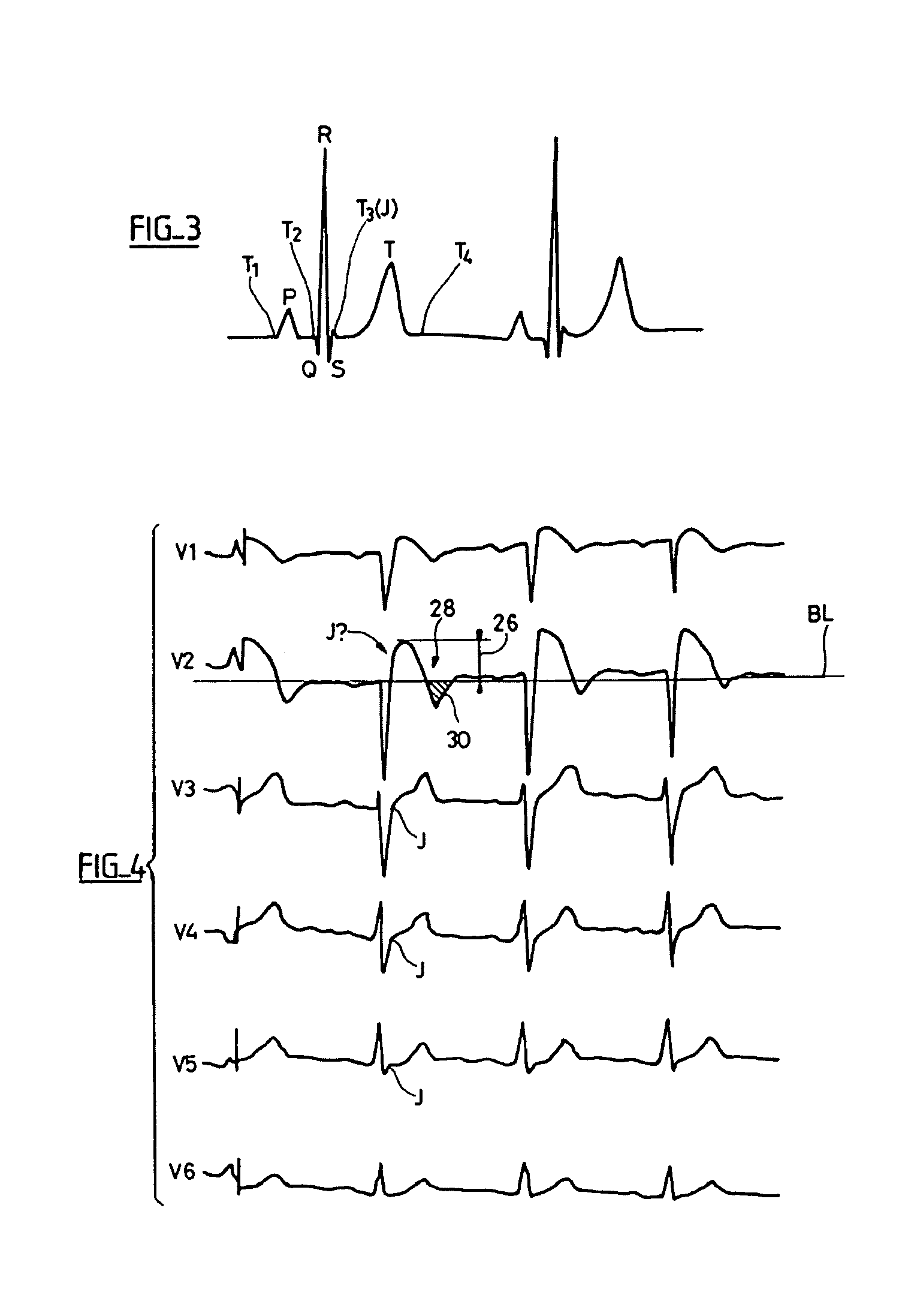 Electrocardiologic device for the assisted diagnosis of brugada syndrome or early repolarization syndrome