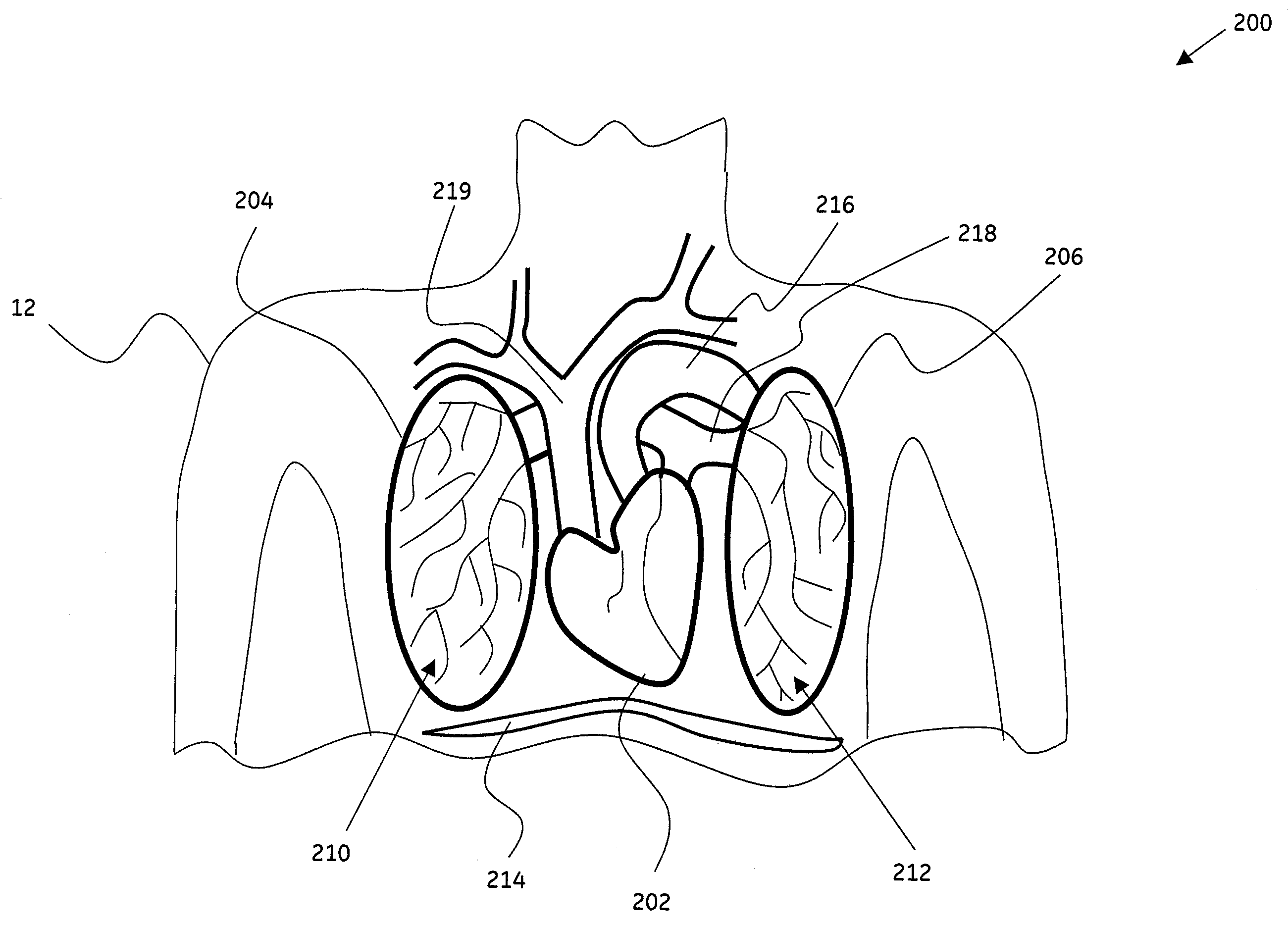 Method and system for detection of obstructions in vasculature