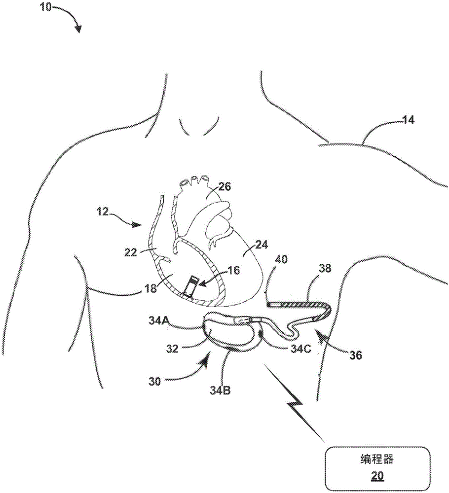 Systems and methods for leadless pacing and shock therapy