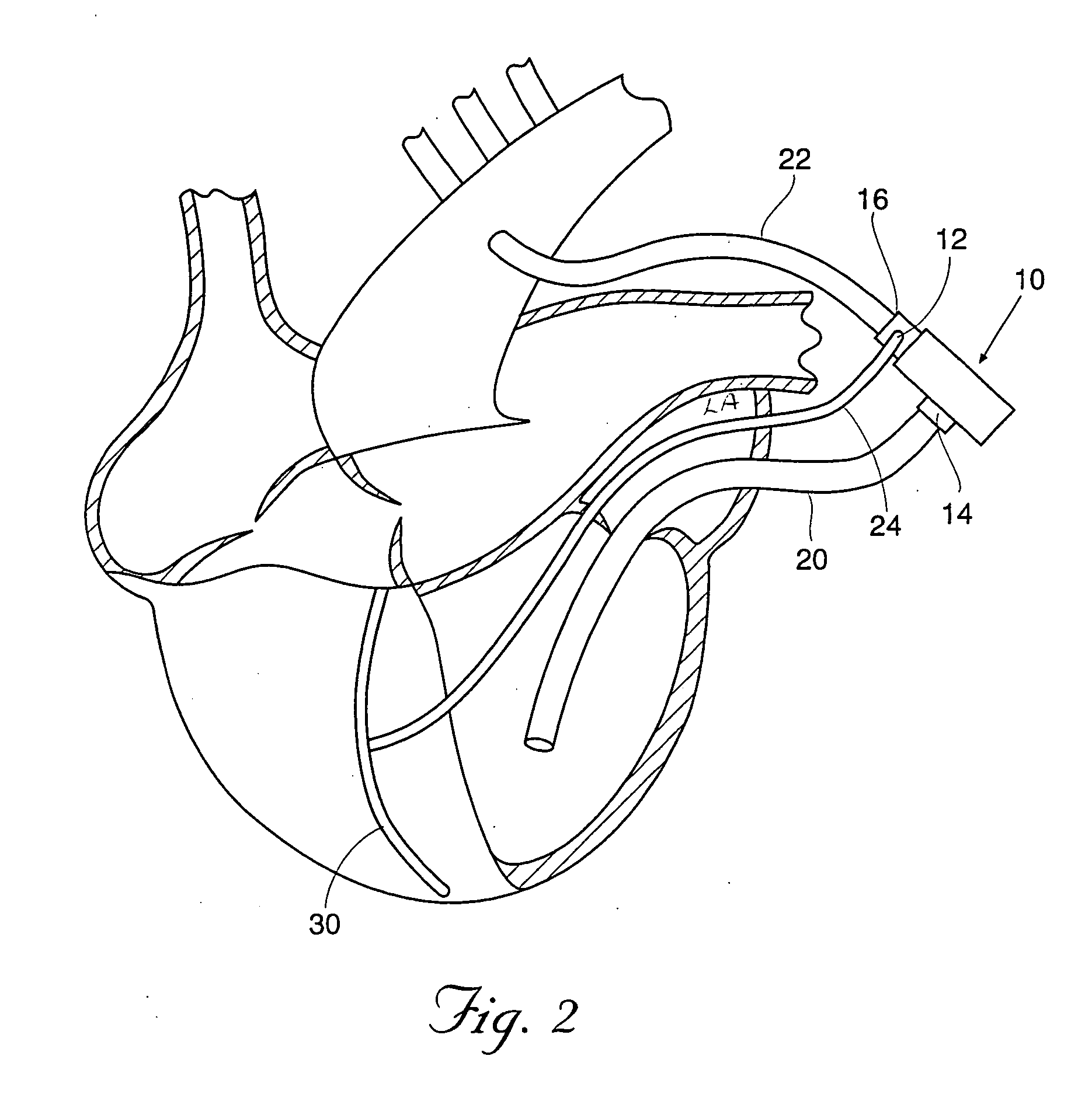 Supplemental port for catheter perfusion of surgical site and methods of use