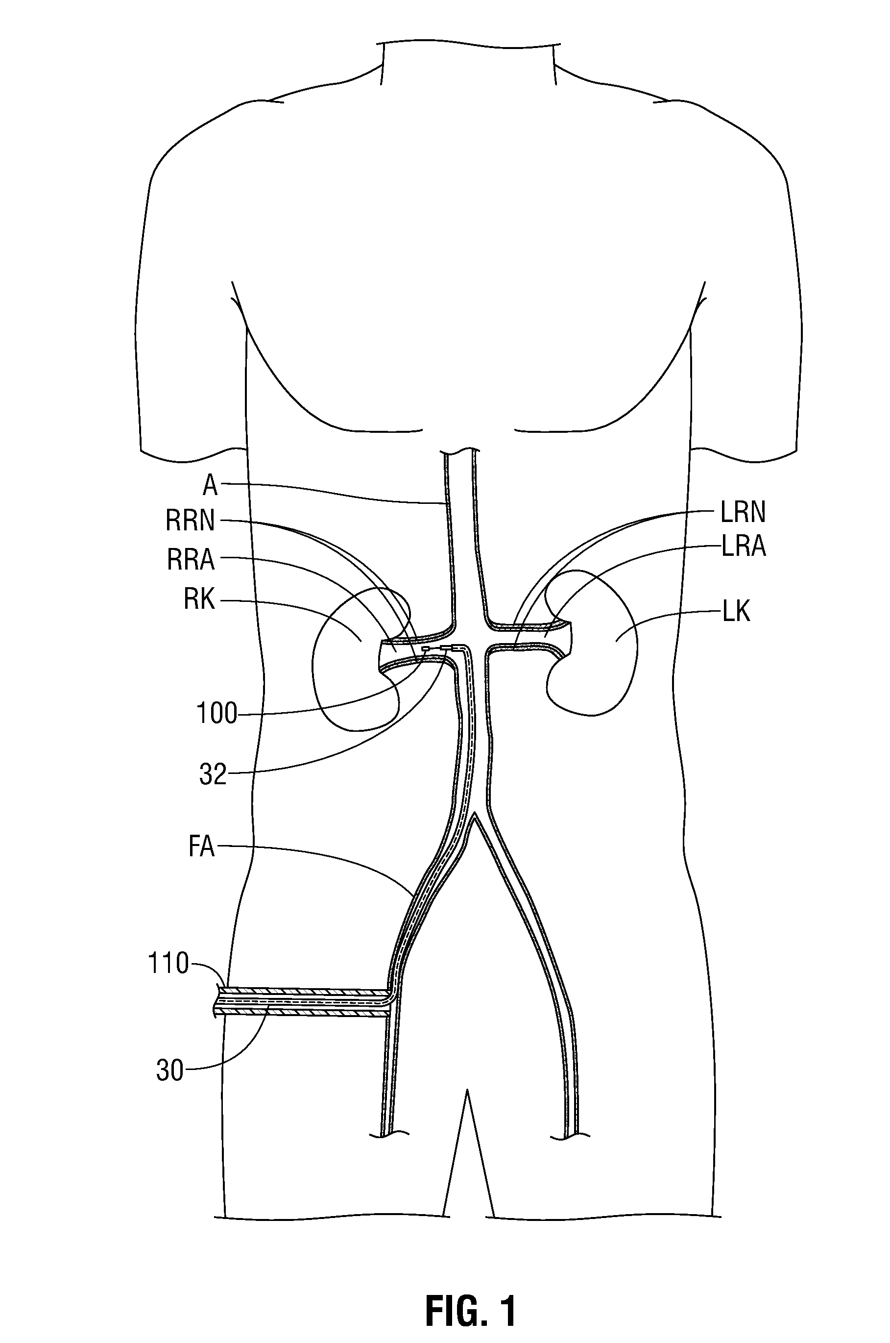 Flexible microwave catheters for natural or artificial lumens