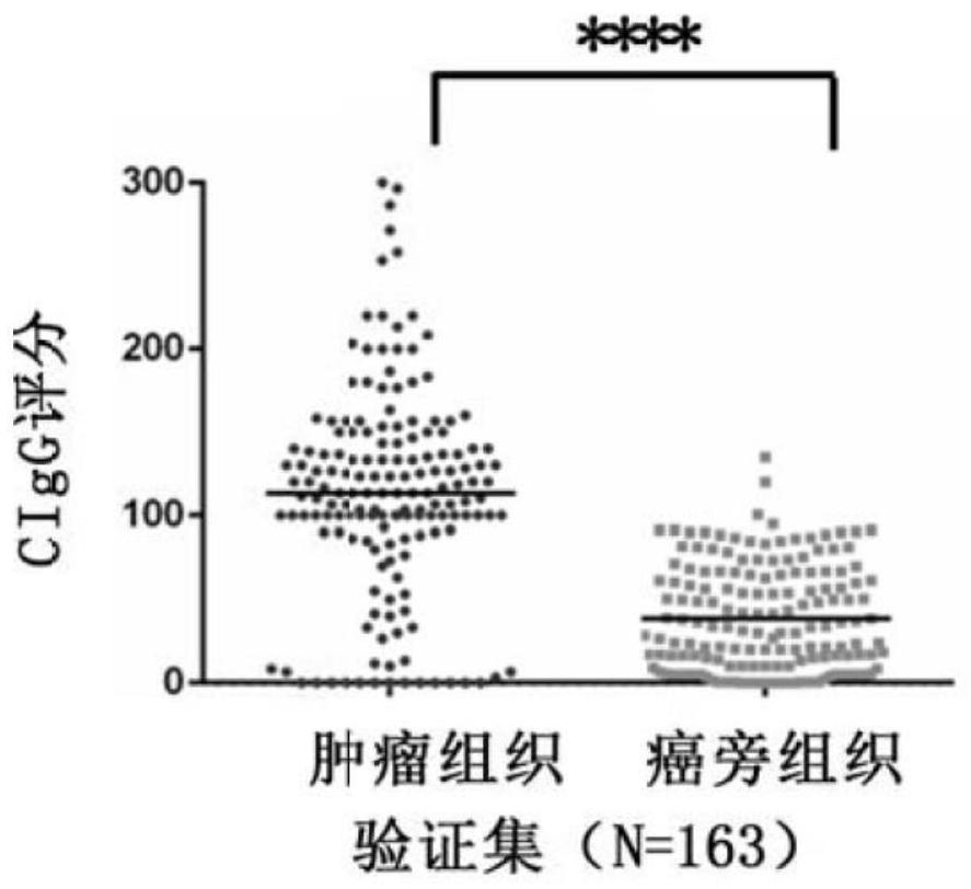 Use of tumor-derived IgG in the diagnosis or prognosis of pancreatic cancer