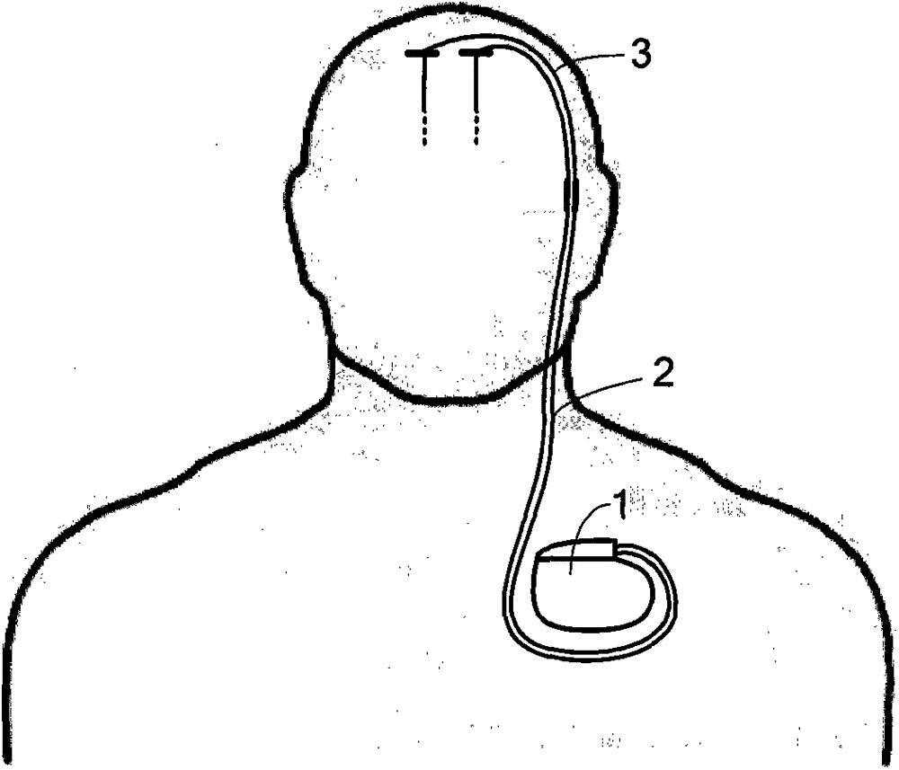 A deep brain stimulation system implanted in the head