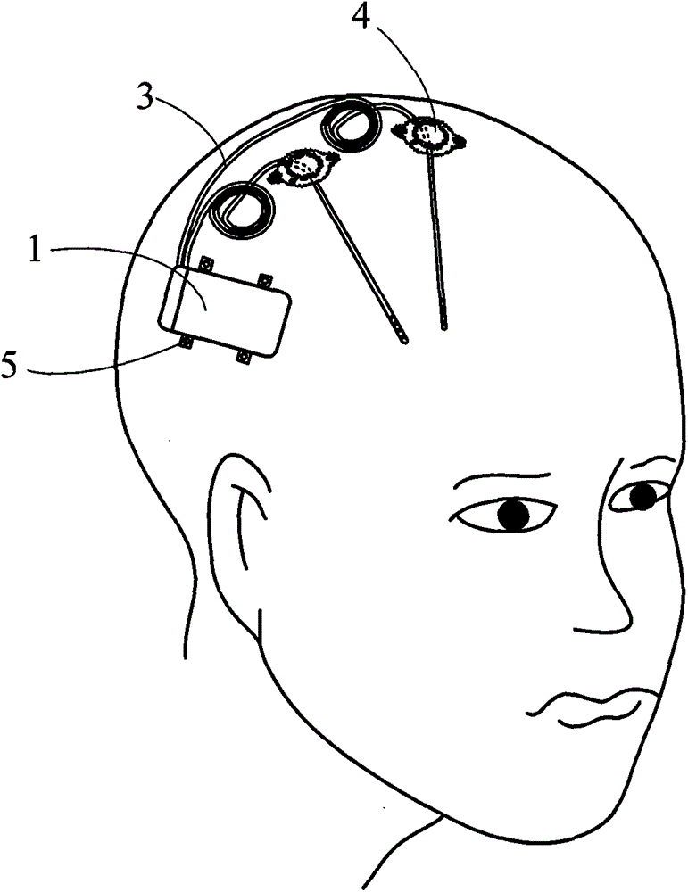 A deep brain stimulation system implanted in the head