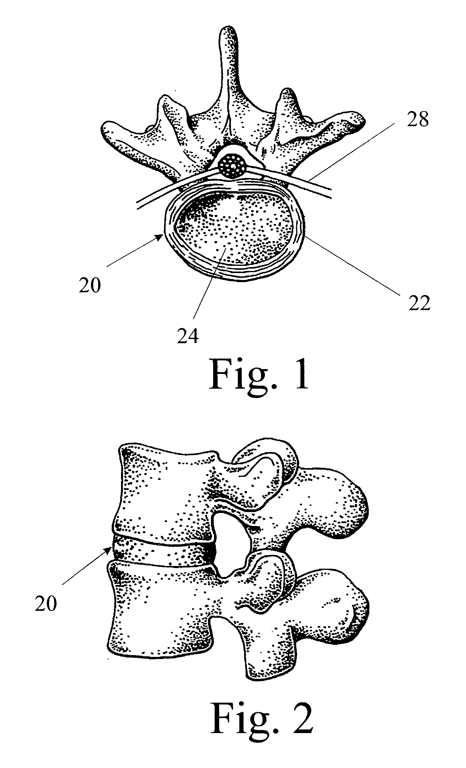 Multiportal device and method for percutaneous surgery