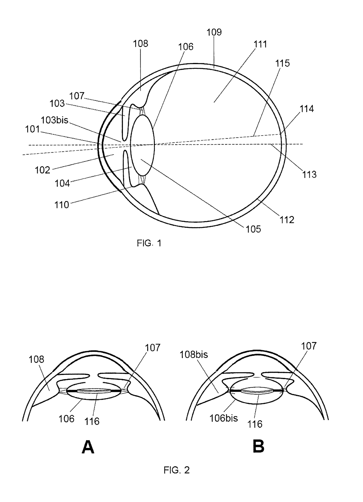 Variable-power accommodative intraocular lens and assembly of variablepower accommodative intraocular lens and capsular ring