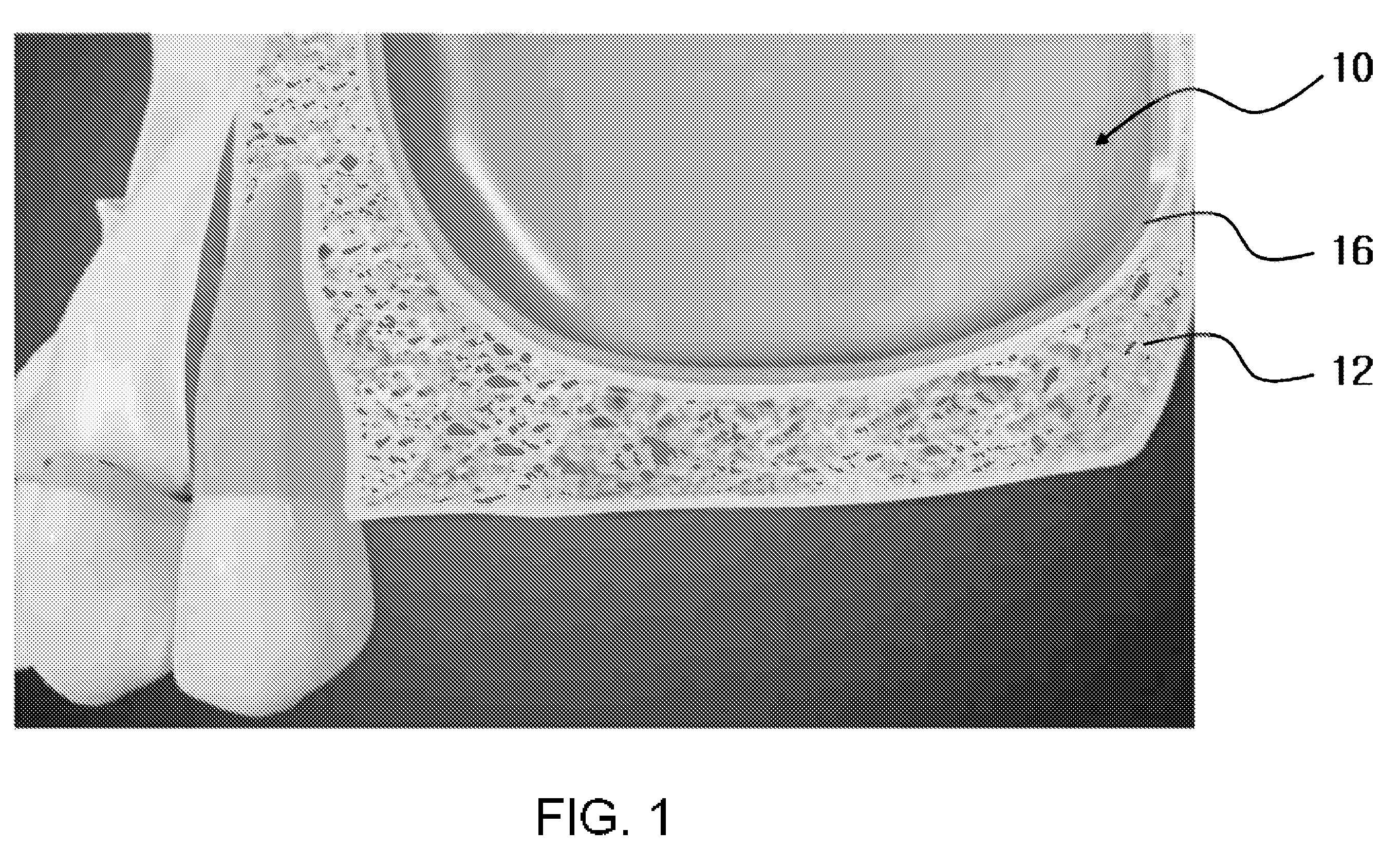 Method of maxillary sinus bone grafting for placement of implant