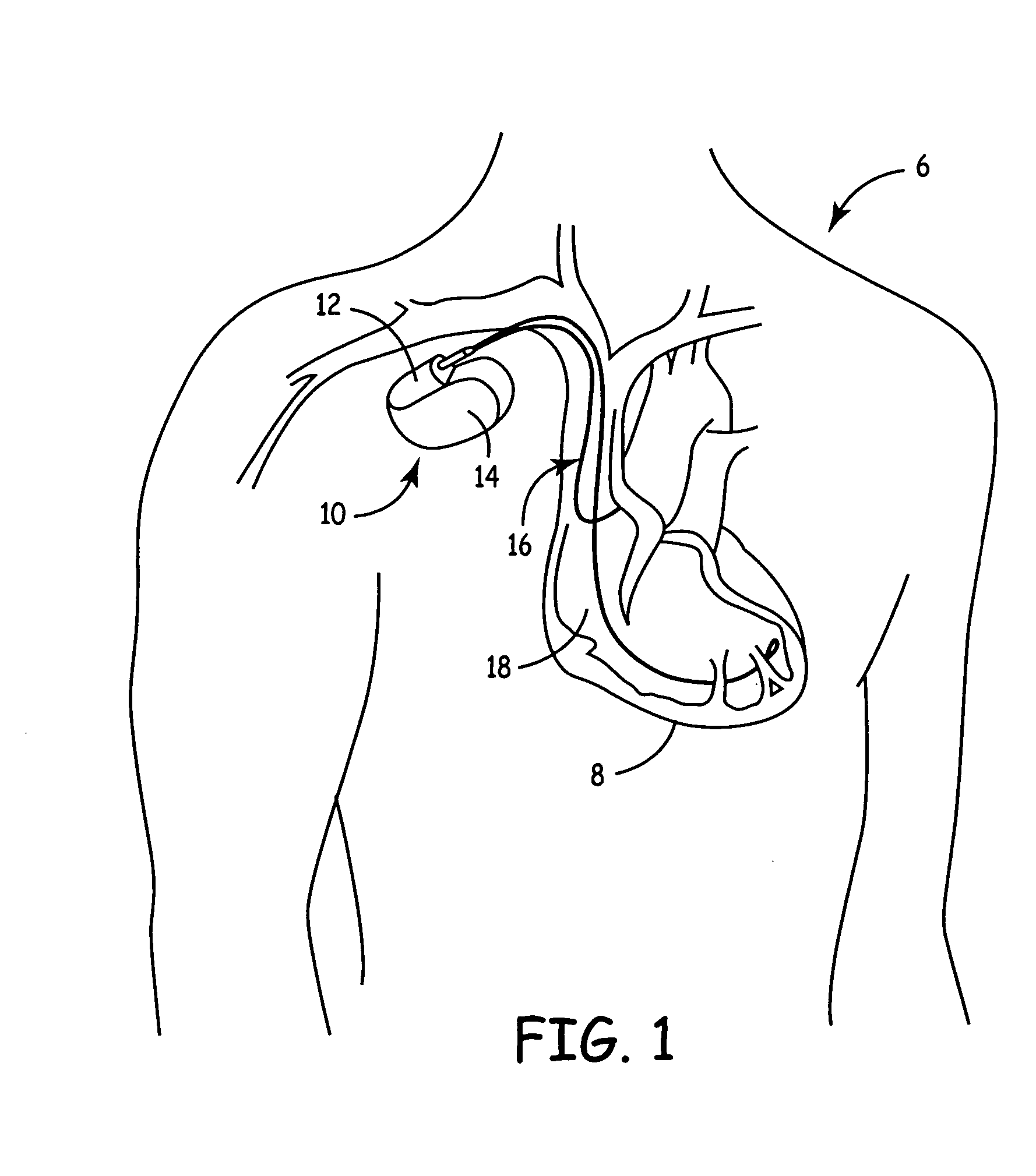 Implantable medical device with ventricular pacing management of elevated heart rates
