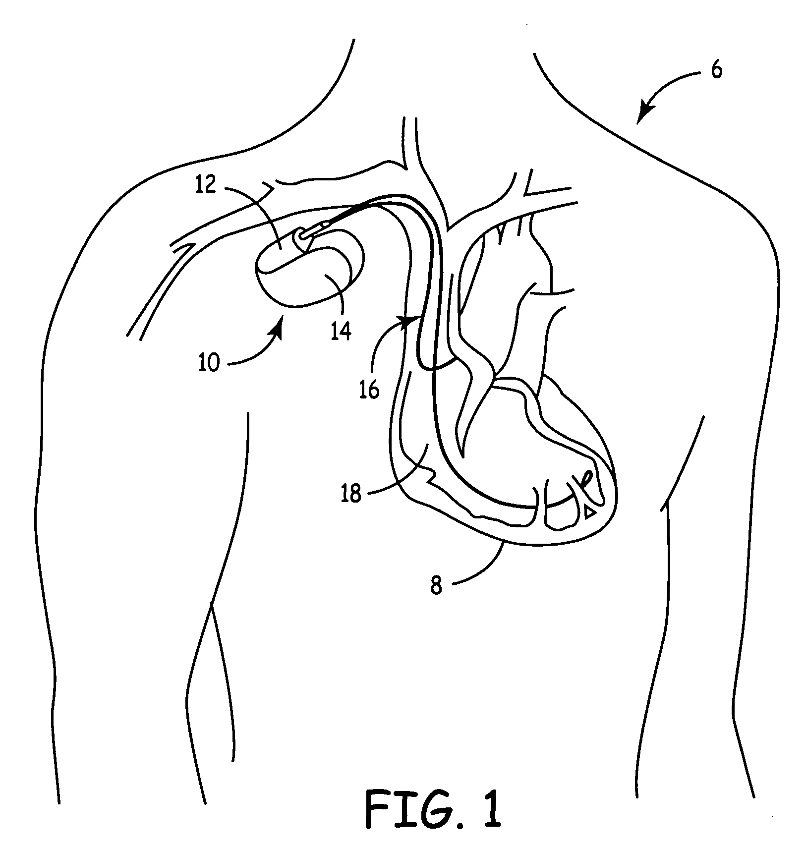 Implantable medical device with ventricular pacing protocol