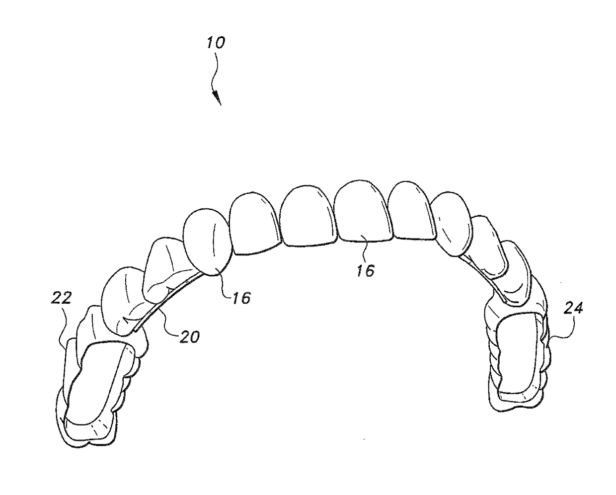 Removable veneers for teeth