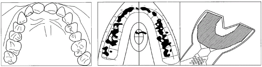 Metal Bite Strip