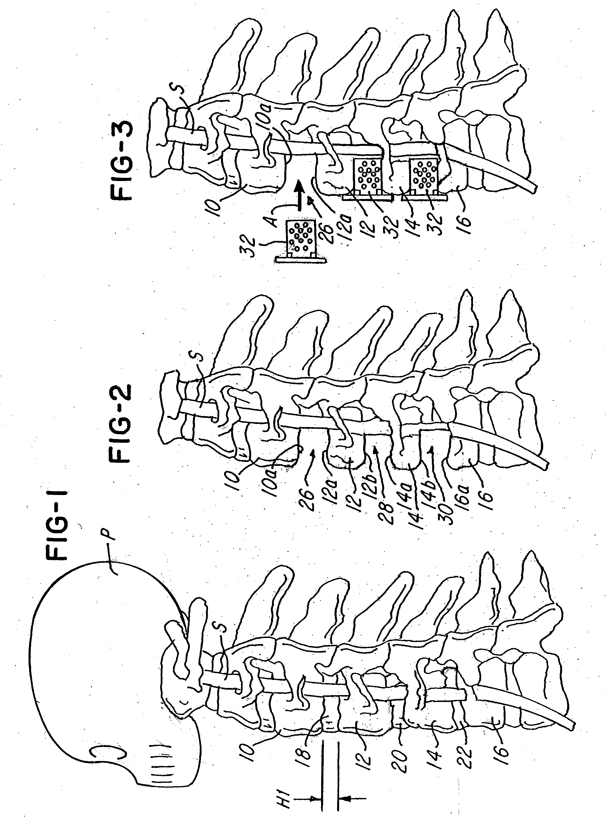 Spinal fusion system utilizing an implant plate having at least one integral lock