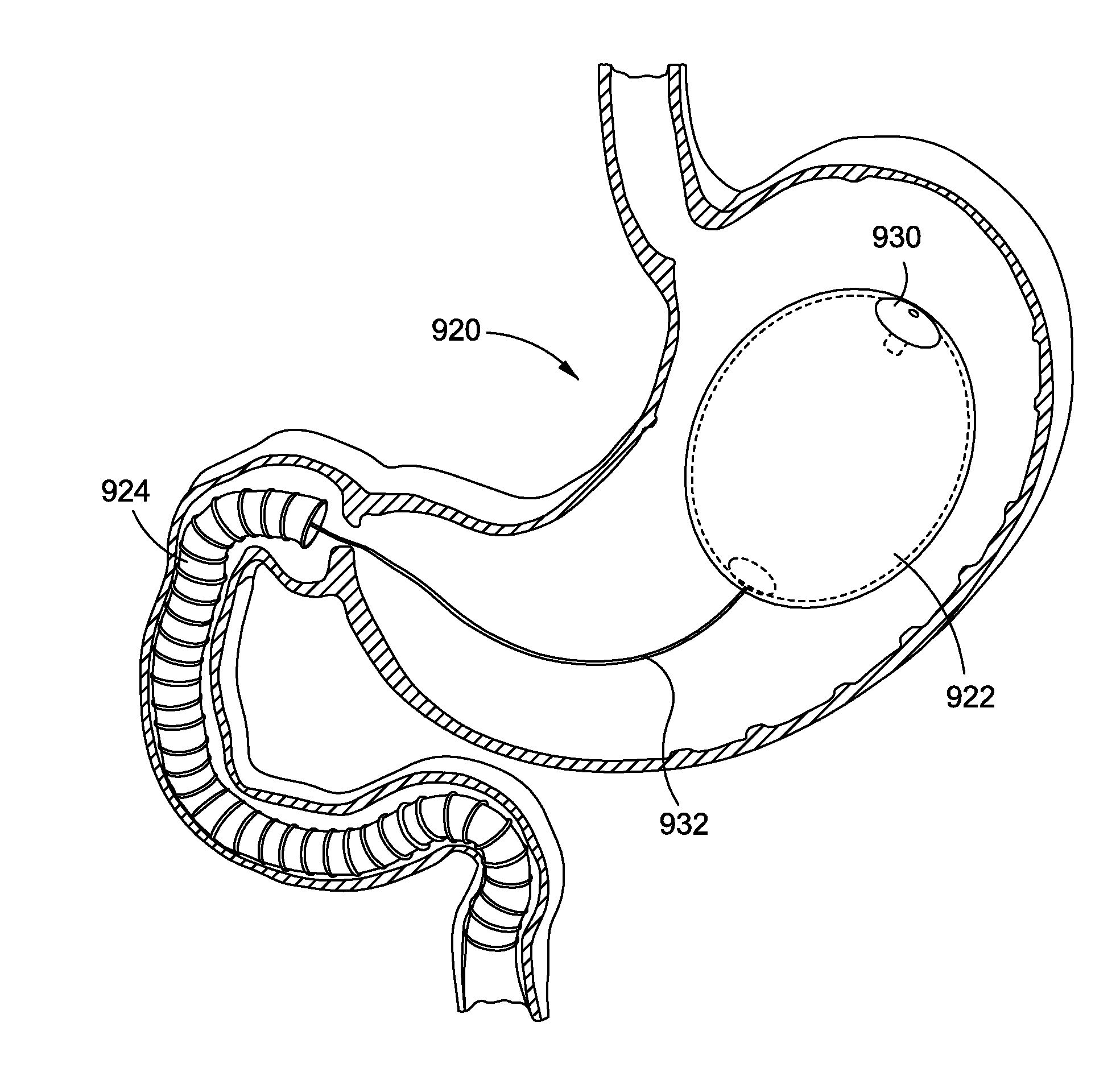 Intragastric implants with duodenal anchors
