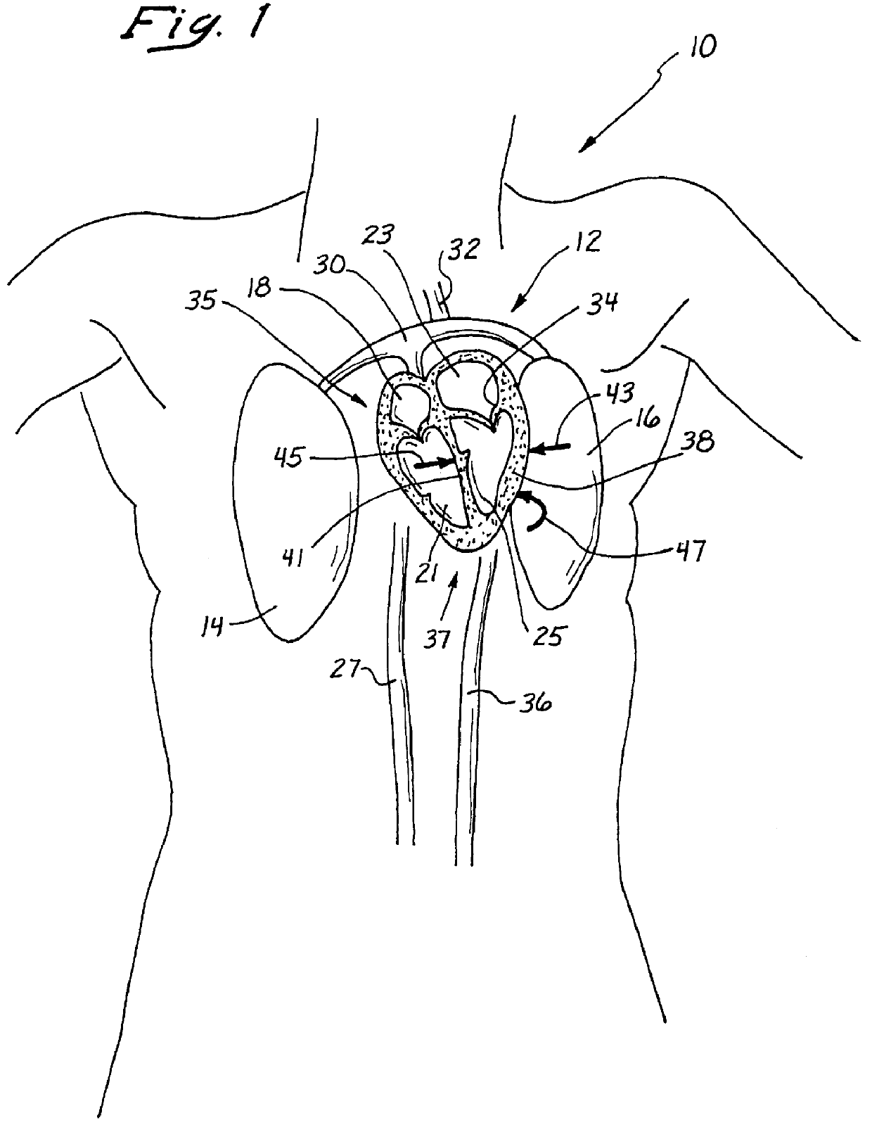 Anterior segment ventricular restoration apparatus and method