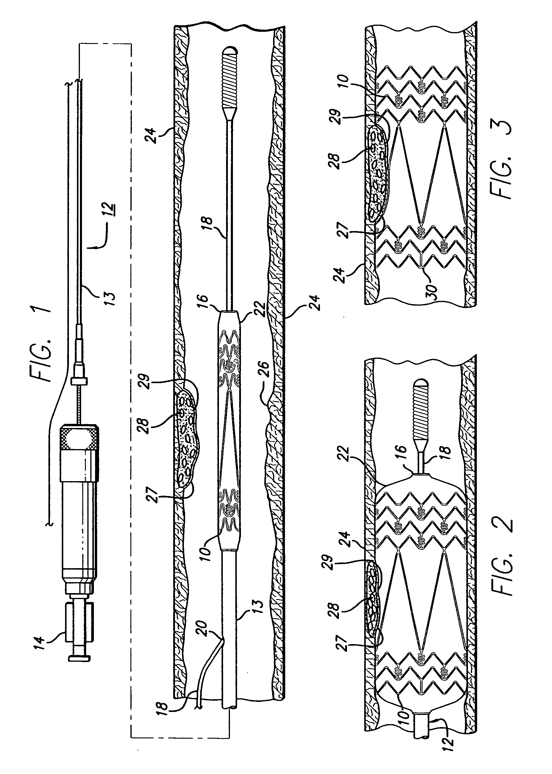 Intravascular stent and method of use