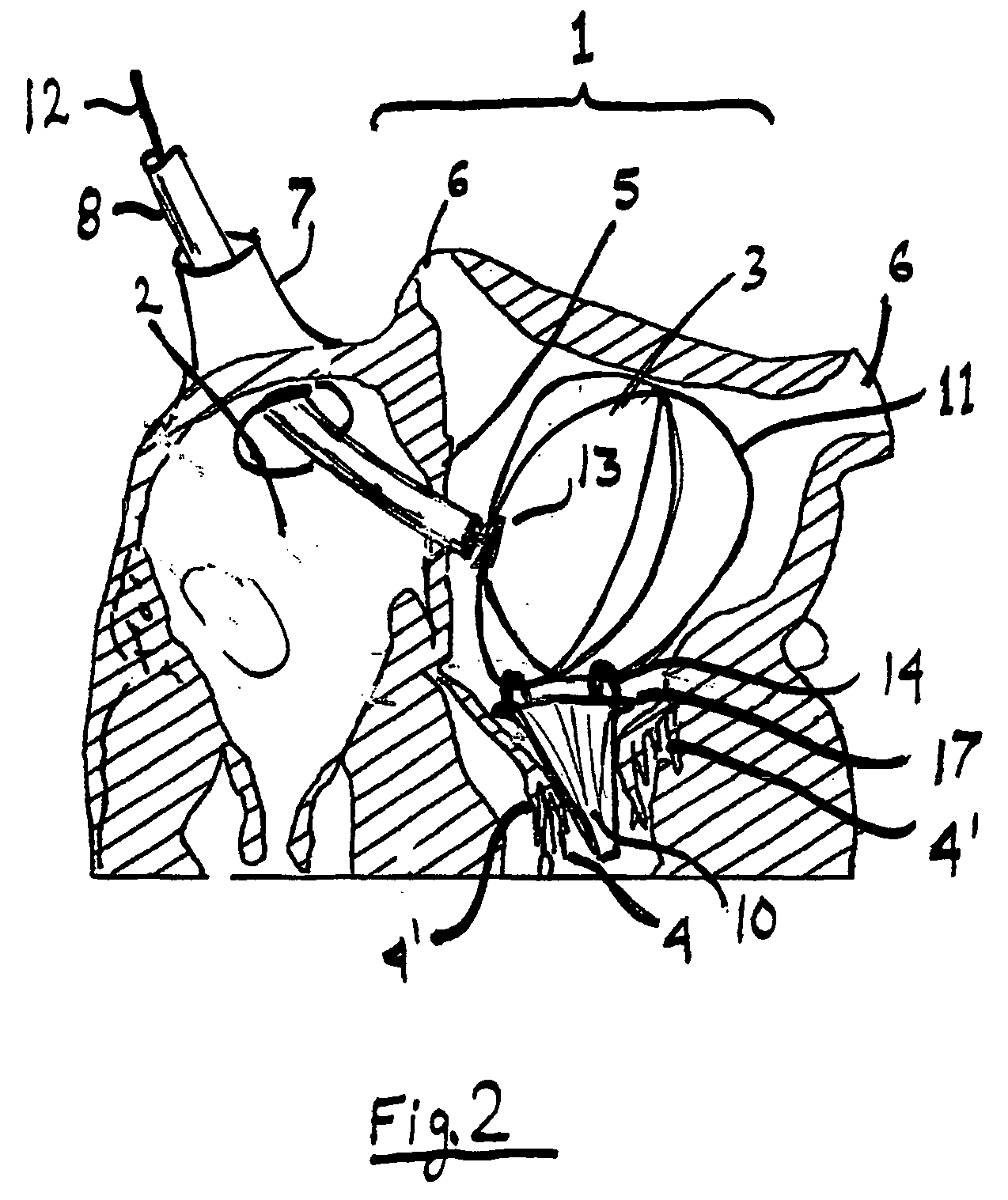 Artificial mitral valve