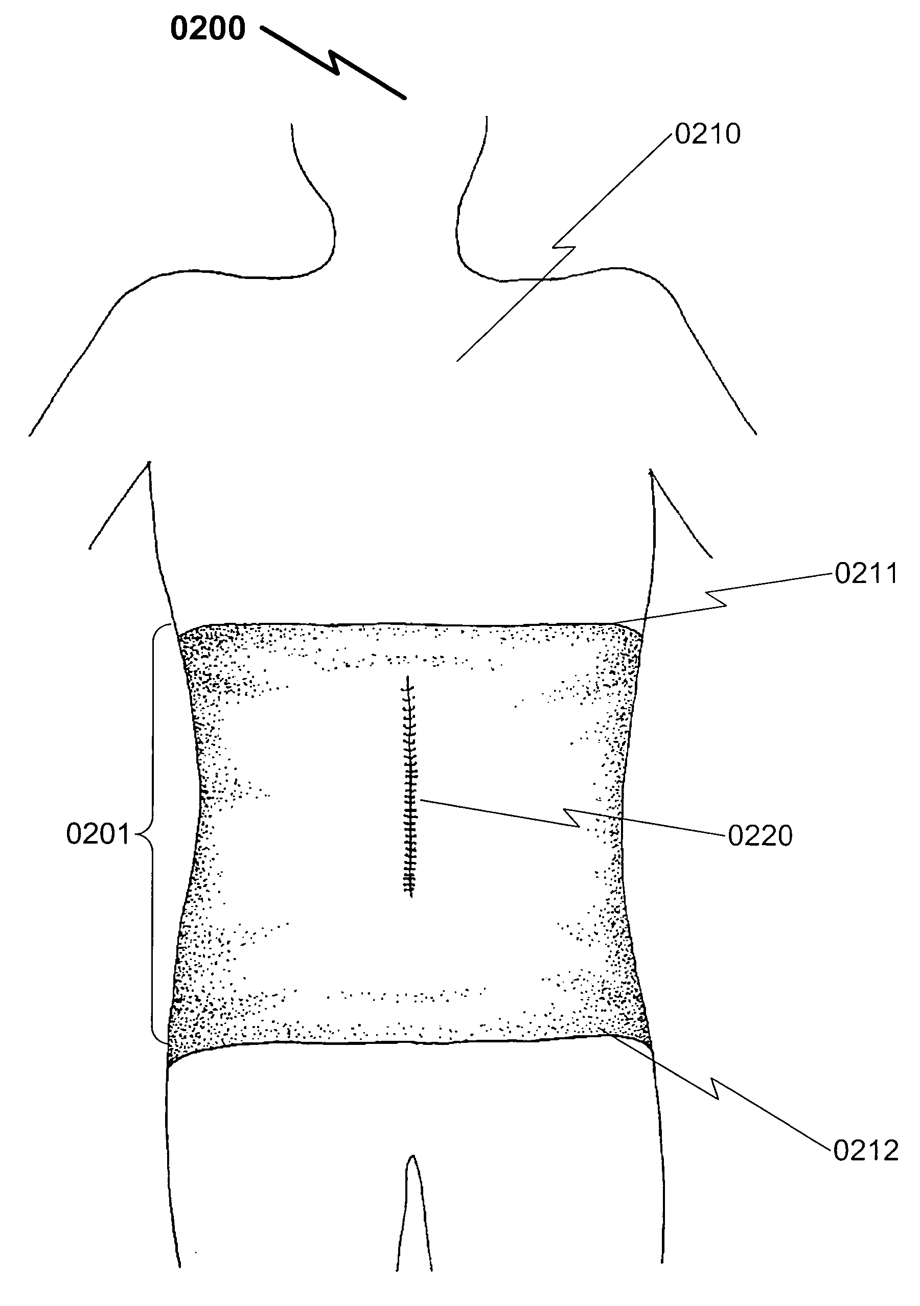 Surgical binder undergarment system and method