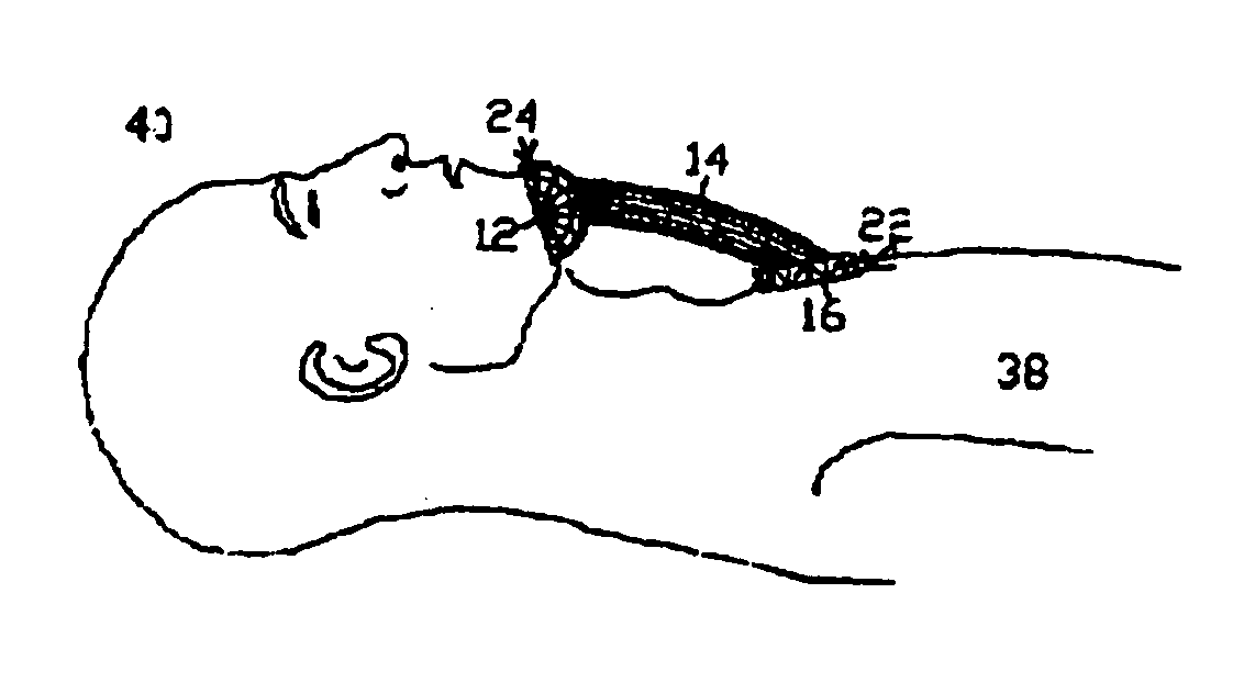 Hands-free chin lift and airway support device