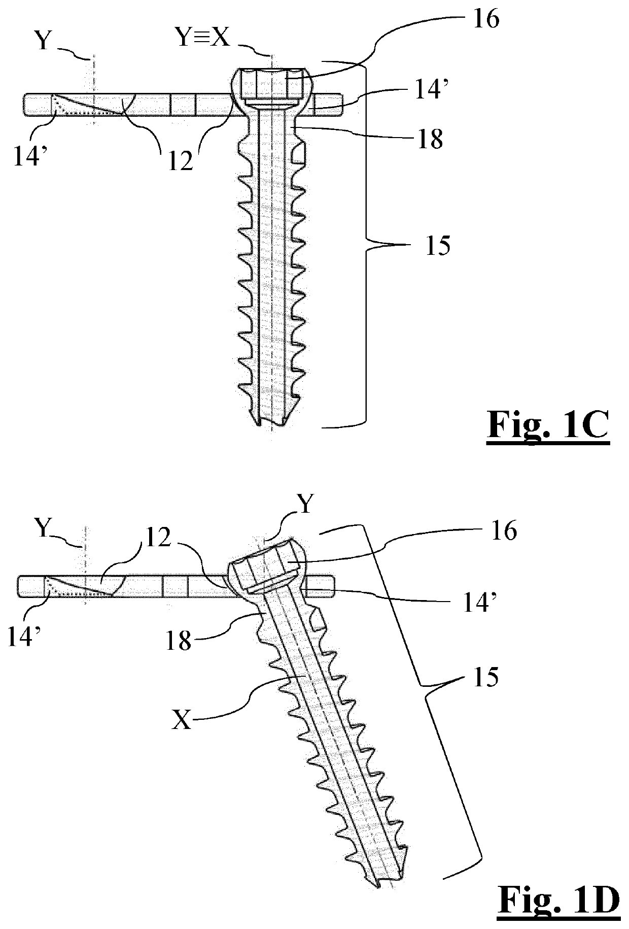 Bone plate for epiphysiodesis