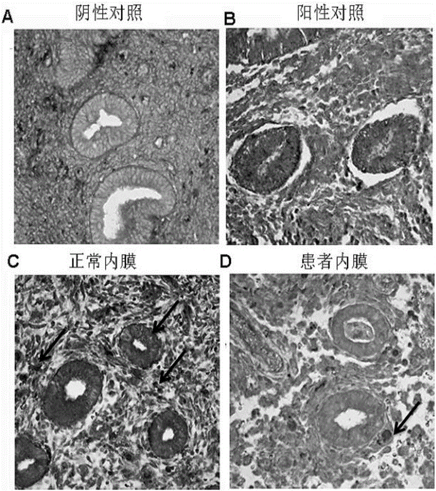 Application of miR-21 in preparation of medicine for treating intrauterine adhesion and/or thin inner membranes