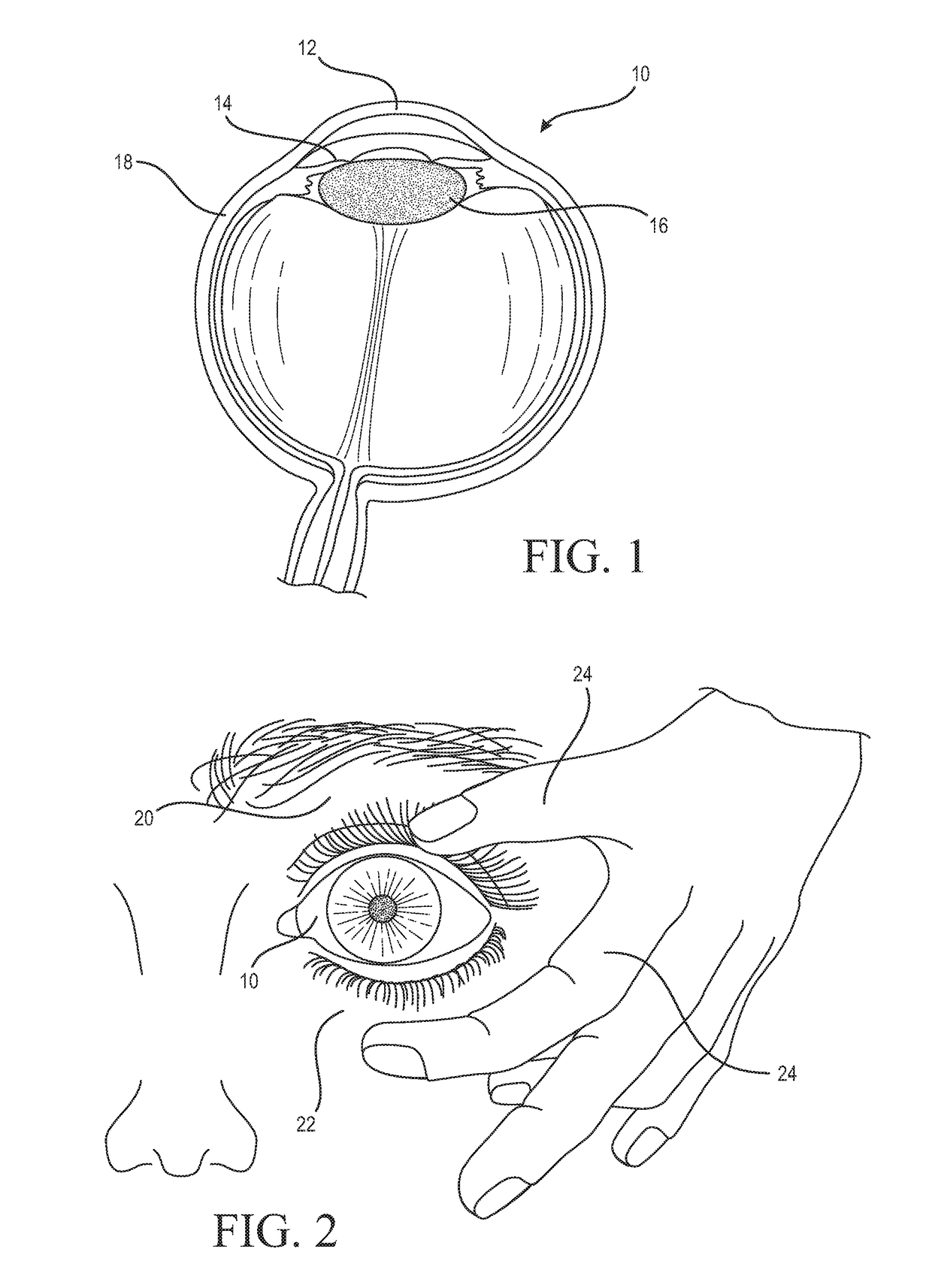 System and method for the delivery of medications or fluids to the eye