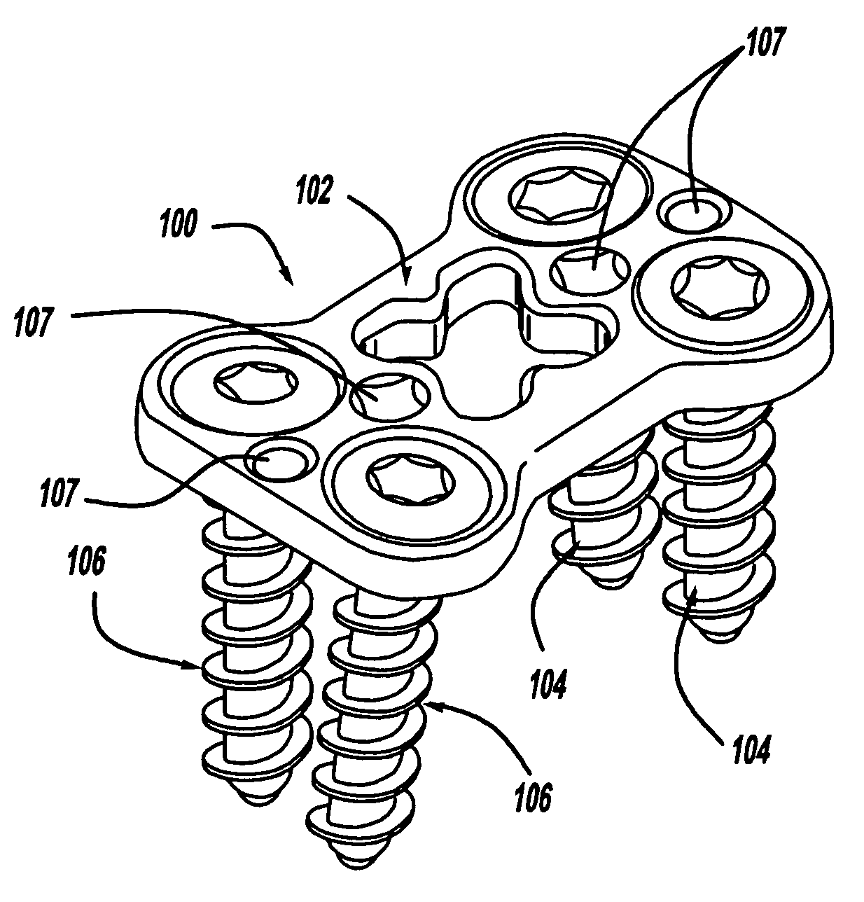 Bone fixation system