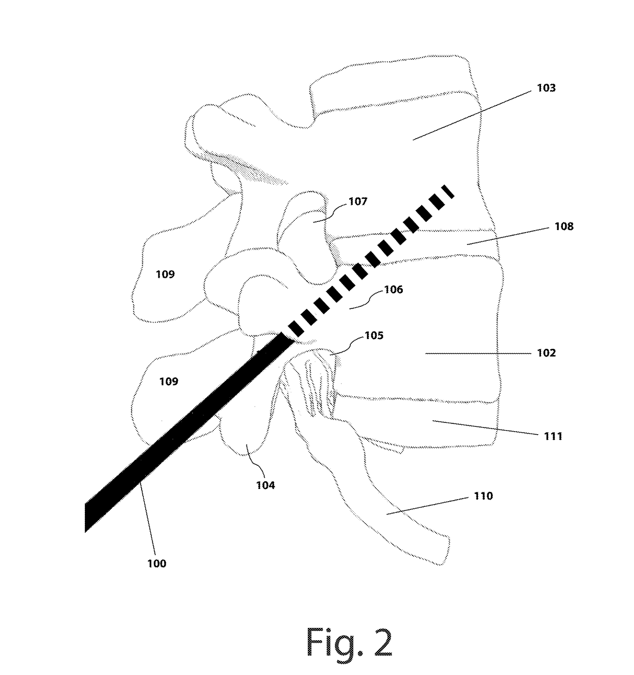 Rodless bivertebral transpedicular fixation with interbody fusion