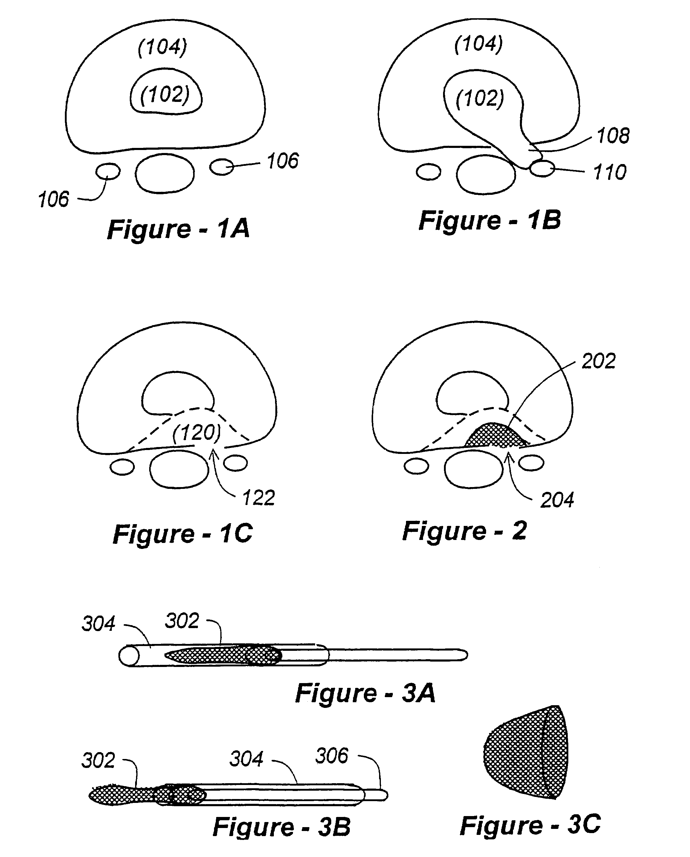 Methods for treating a defect in the annulus fibrosis