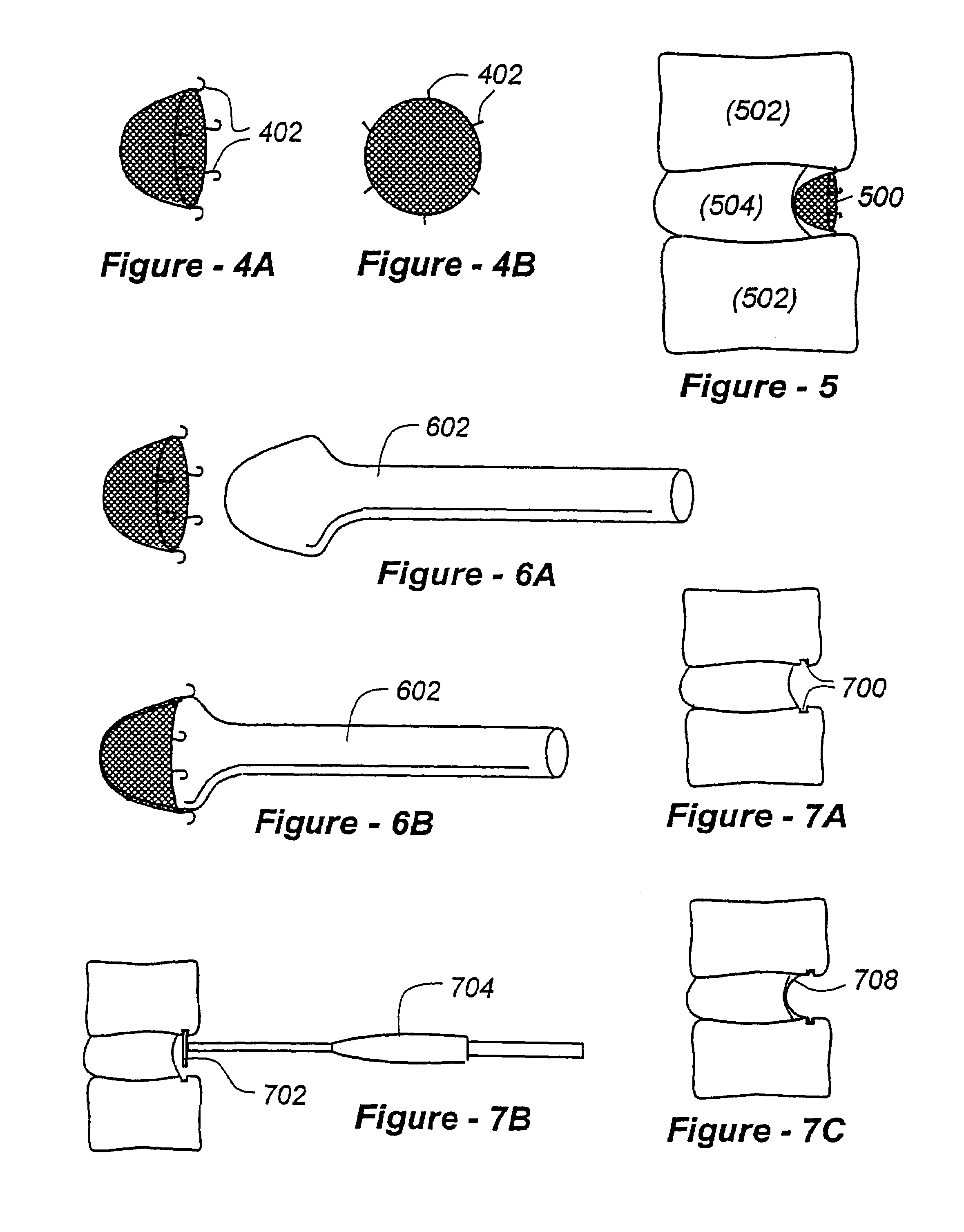 Methods for treating a defect in the annulus fibrosis