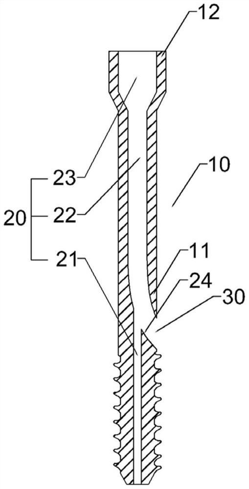 Guiding hollow screw with implantable filler