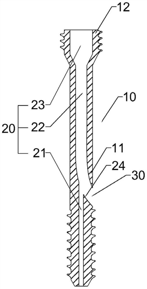 Guiding hollow screw with implantable filler