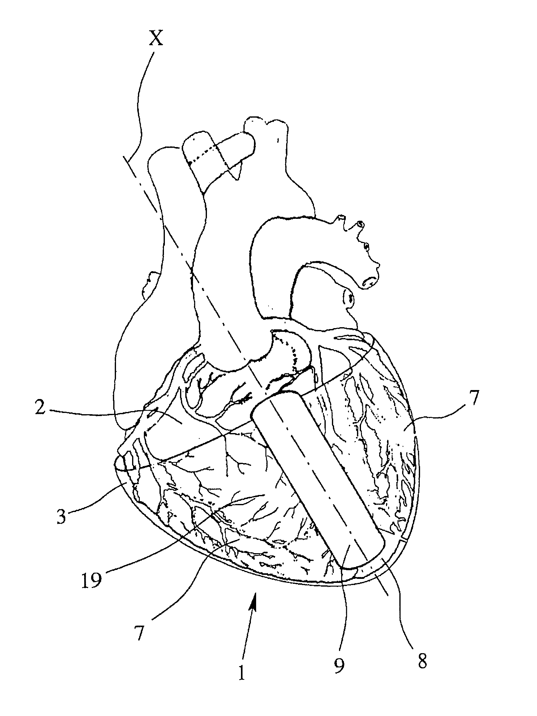 Device and system for assisting and/or taking over the pumping function of the heart