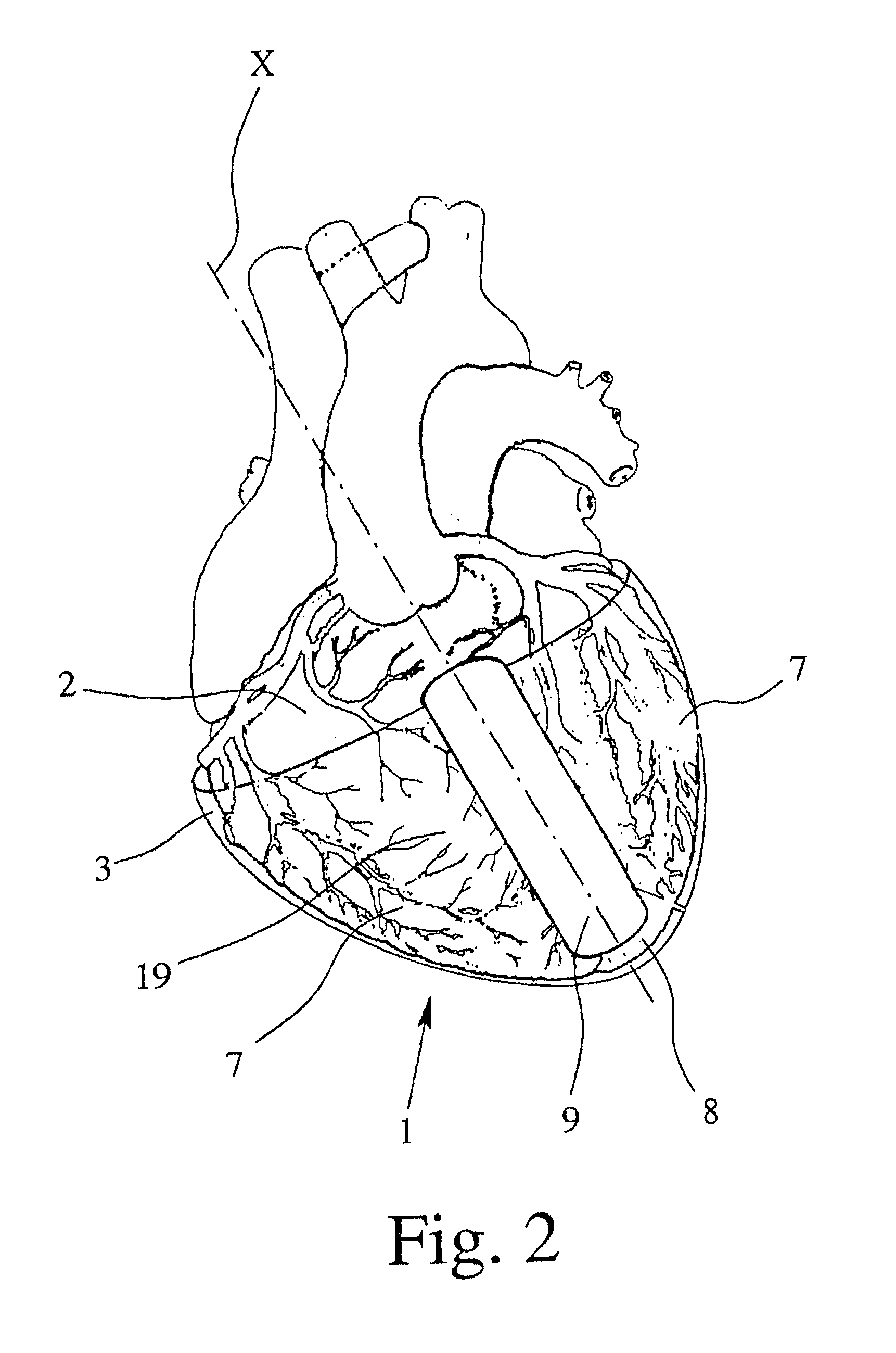 Device and system for assisting and/or taking over the pumping function of the heart