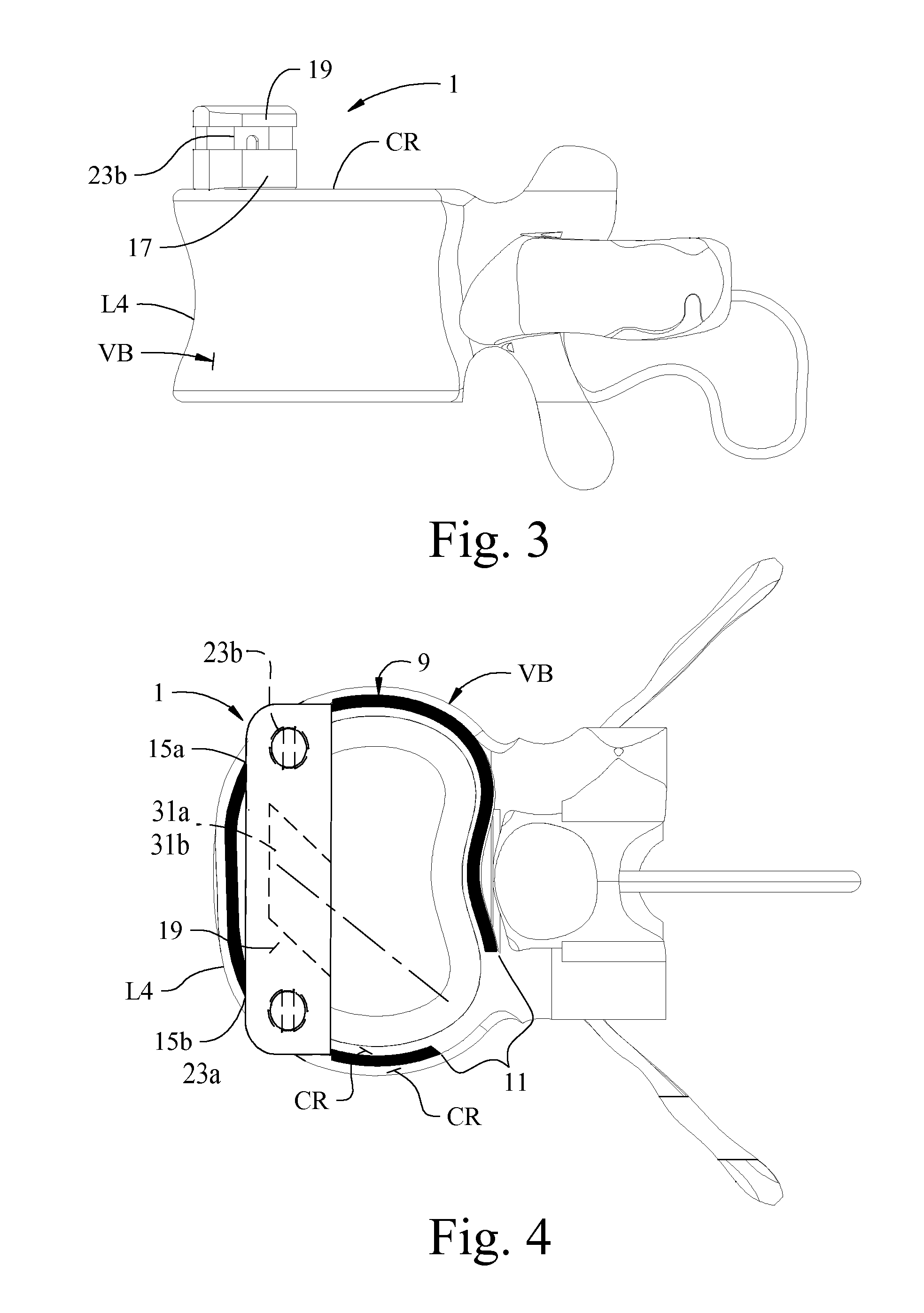 Expandable interbody implant and method