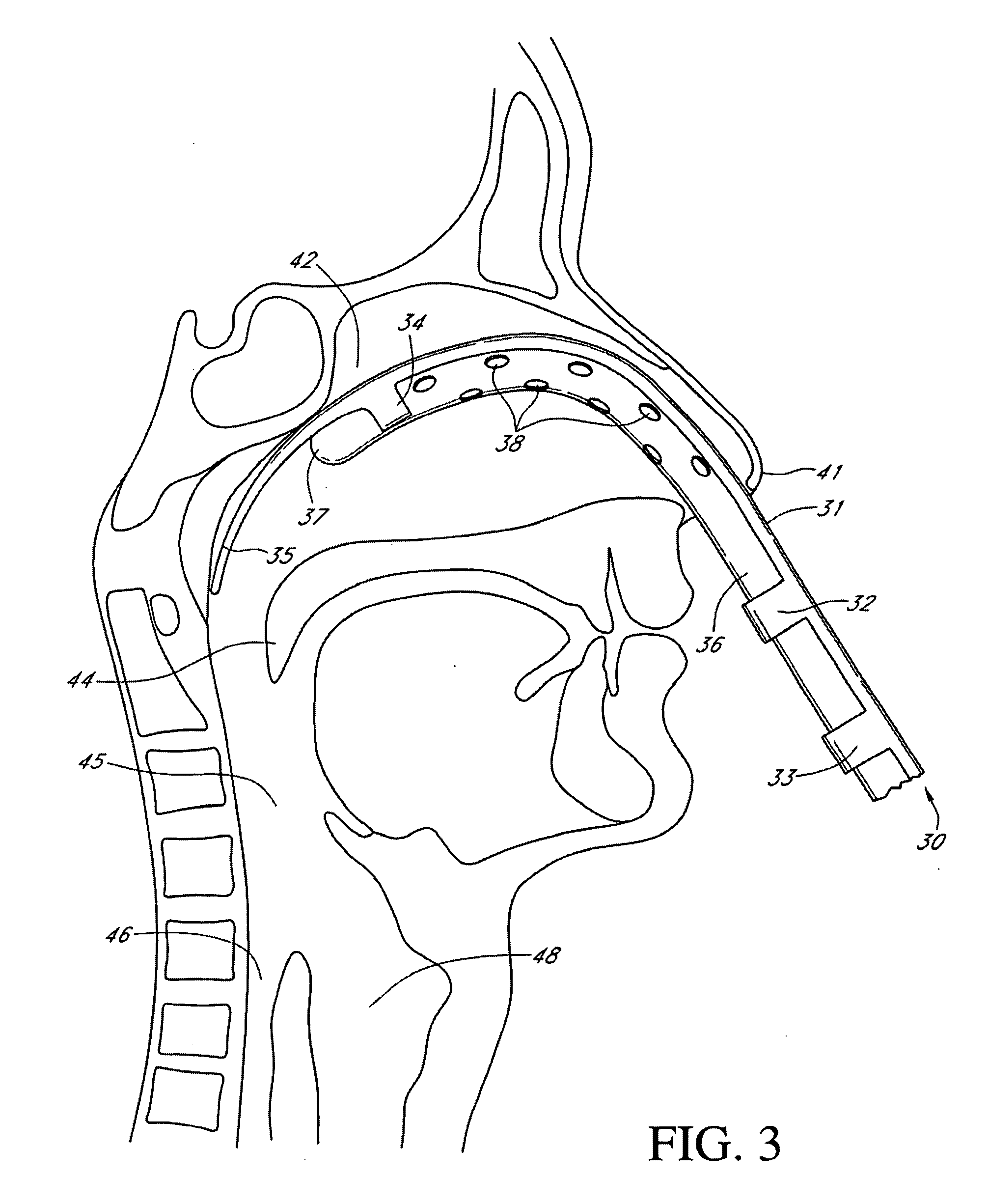 Intubation devices and methods of use thereof