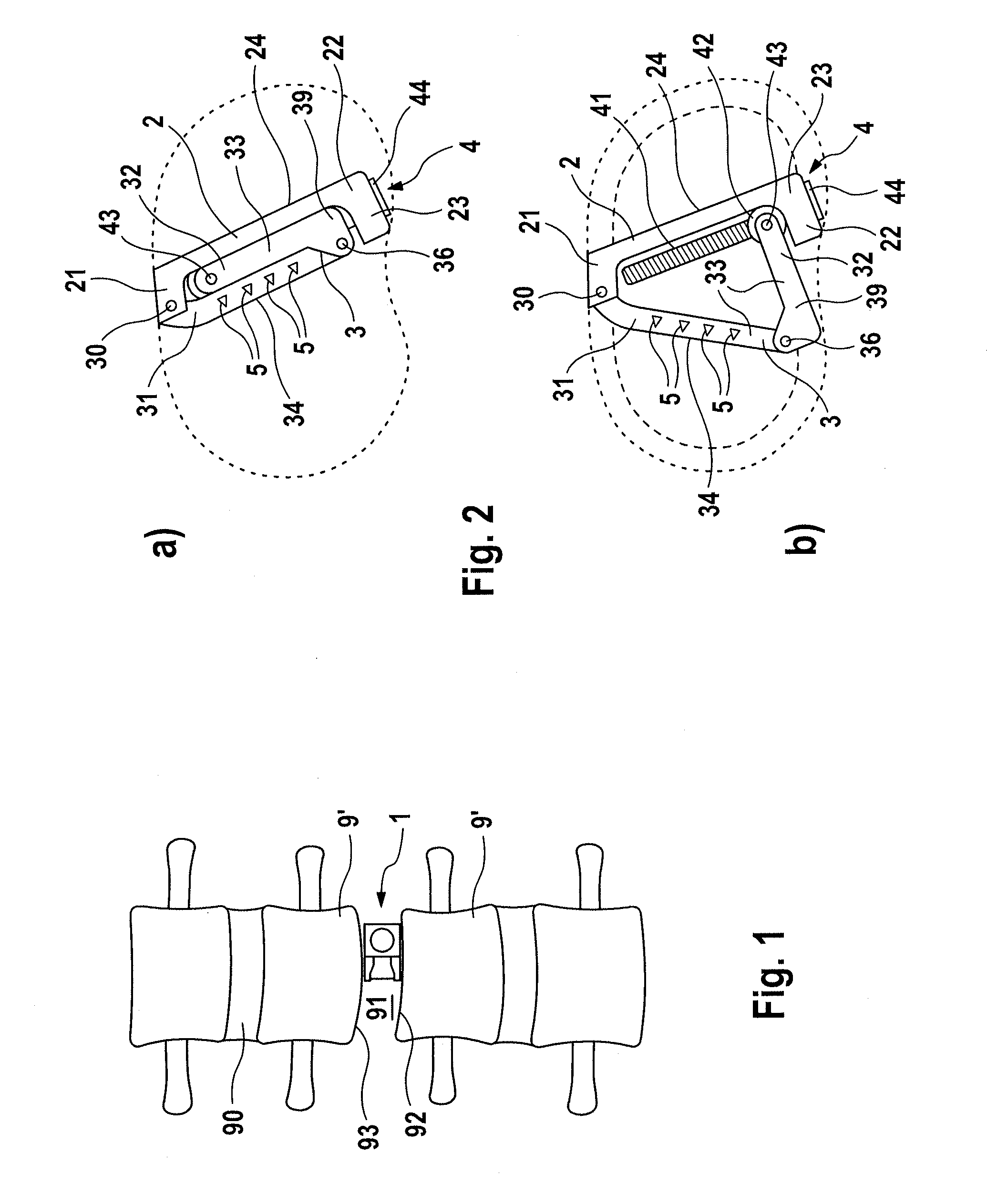 Laterally expandable intervertebral fusion implant