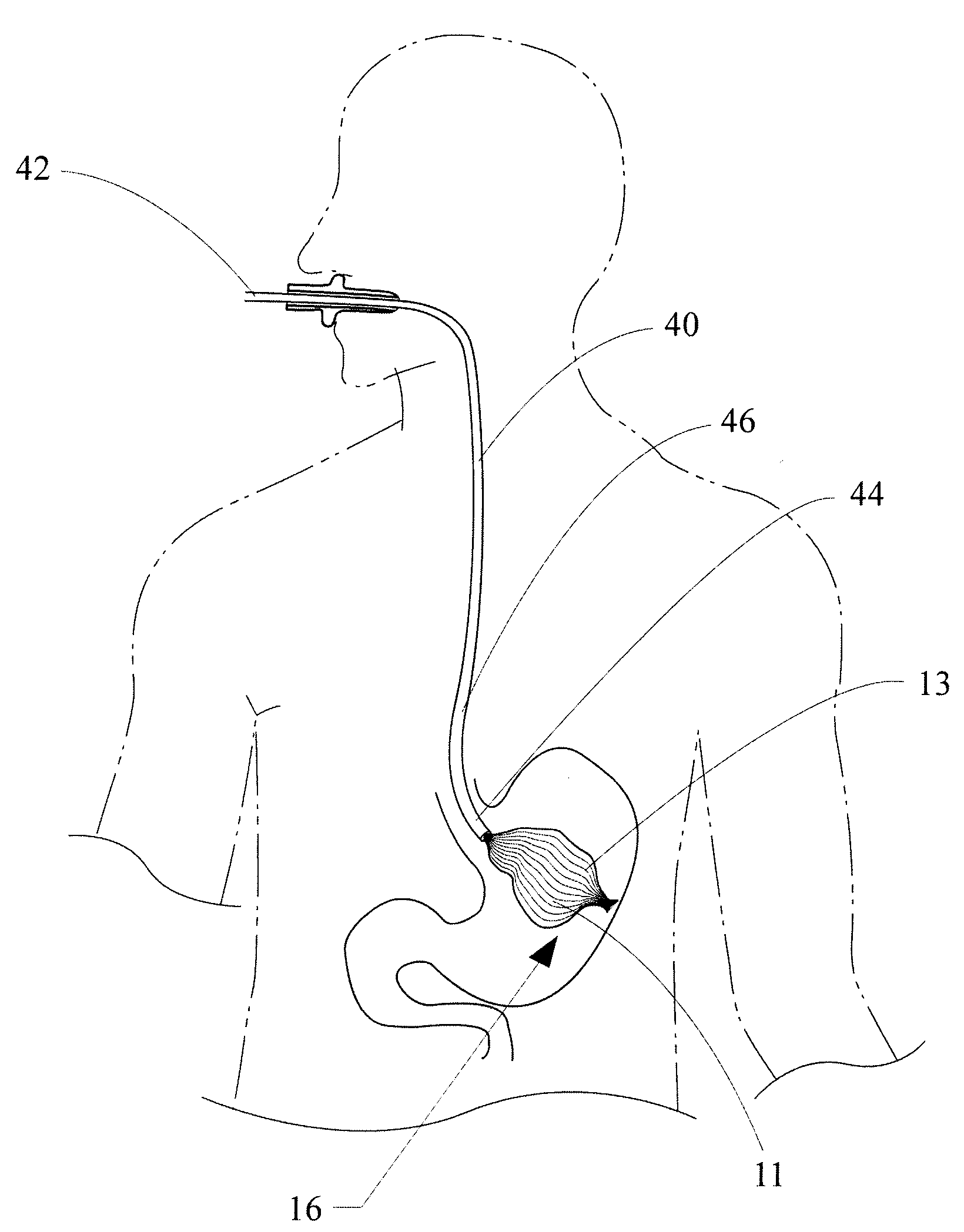 Intragastric bag apparatus and method of delivery for treating obesity