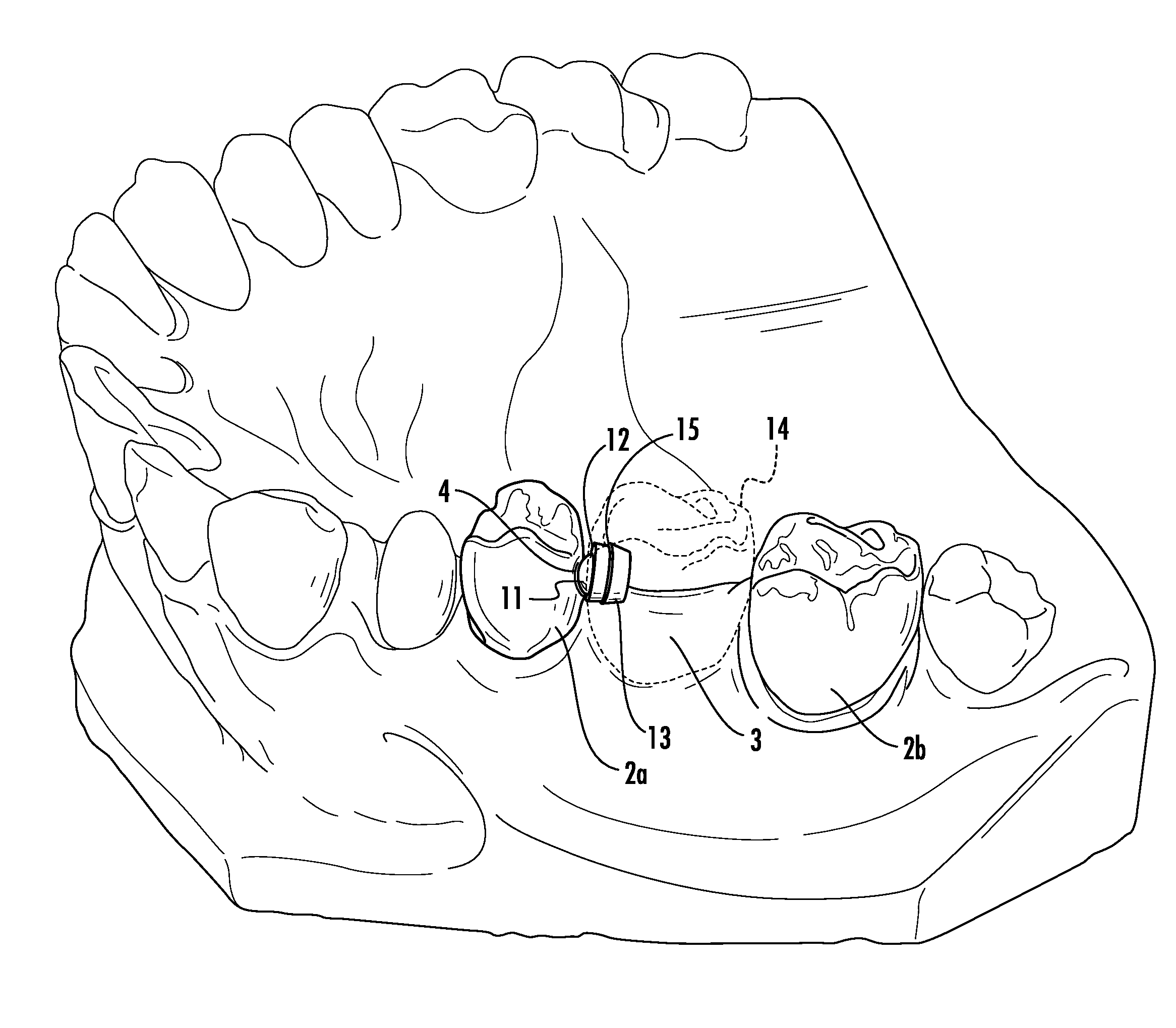 Dental attachment appliance and device