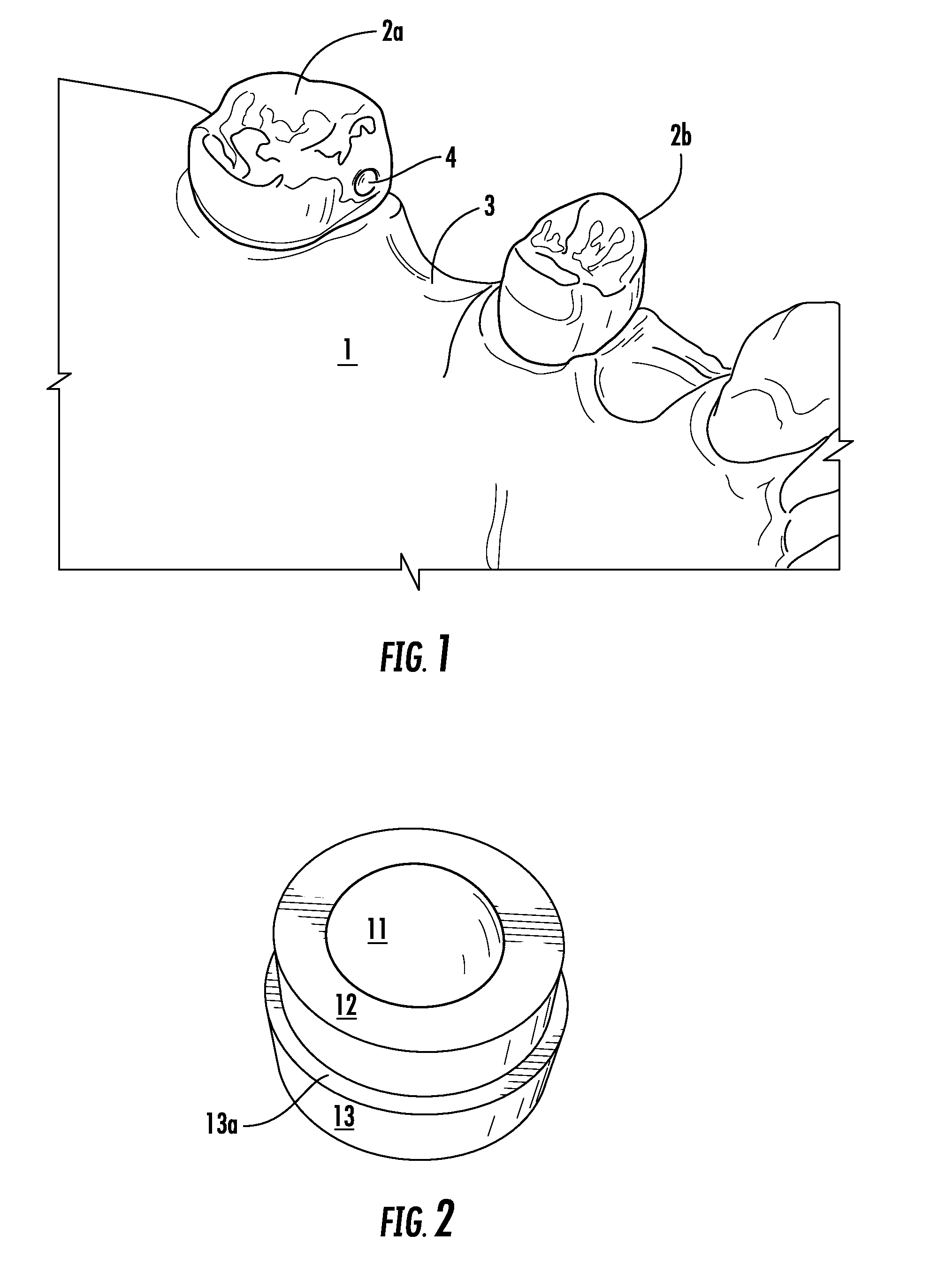 Dental attachment appliance and device