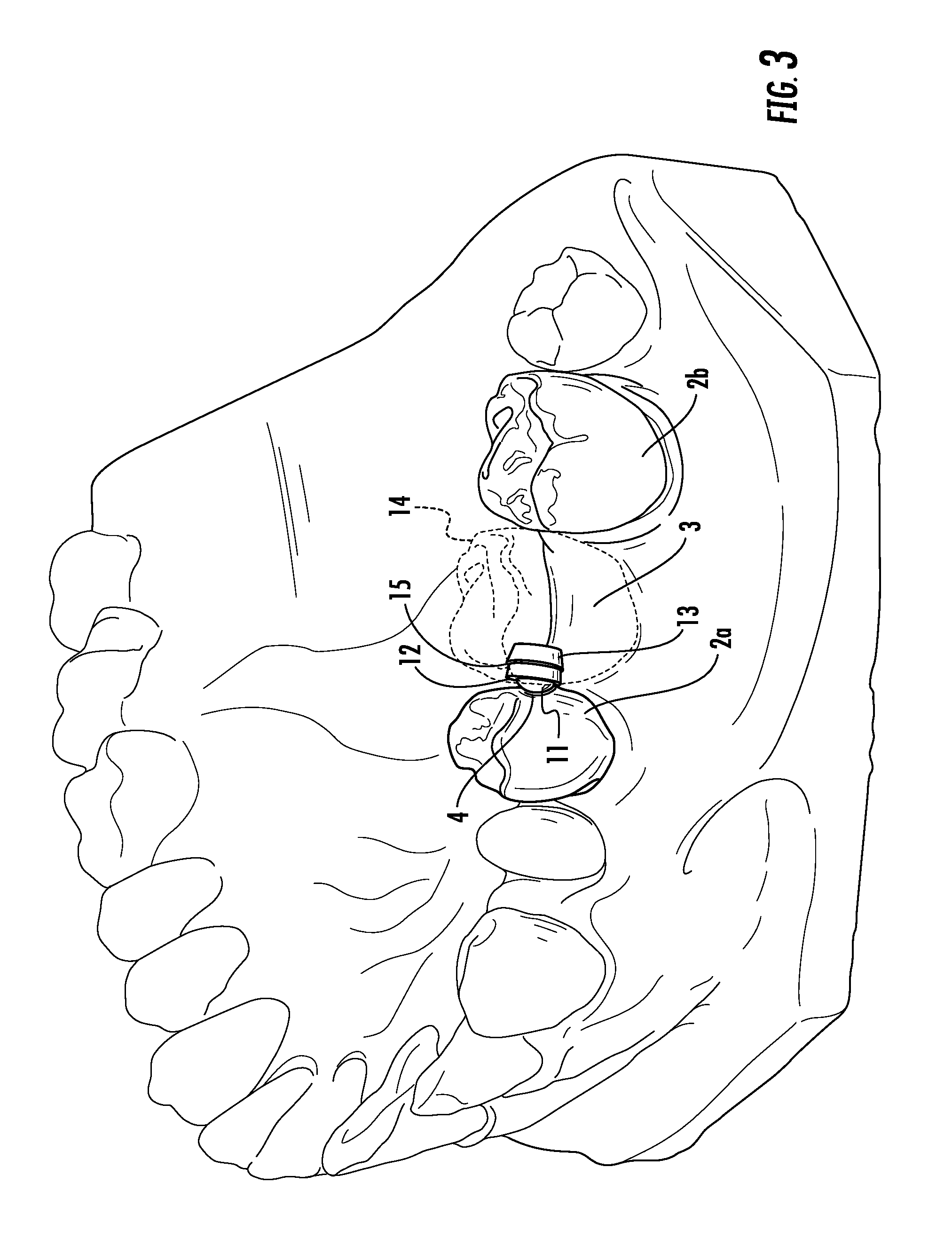 Dental attachment appliance and device