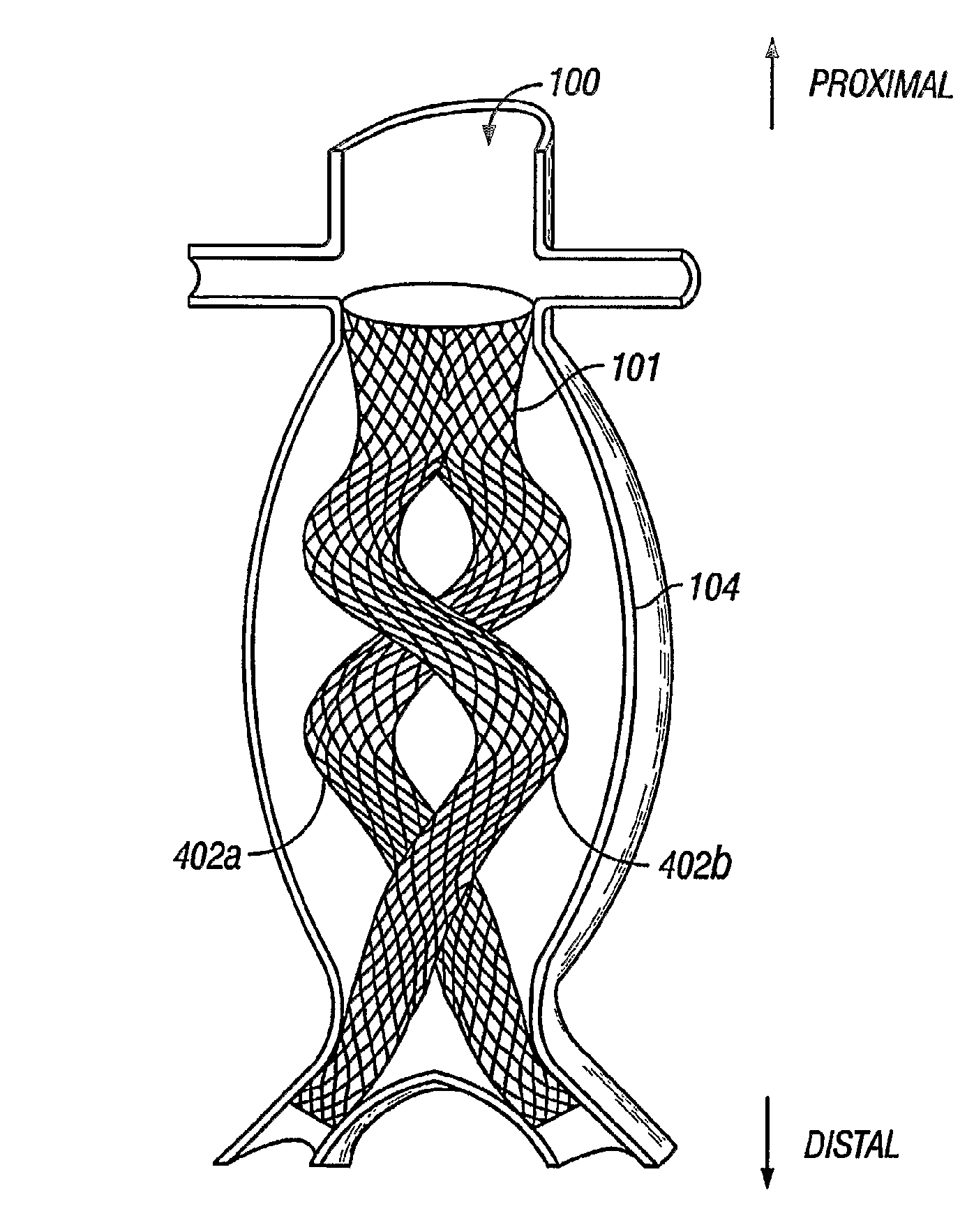 Devices and methods for treatment of abdominal aortic aneurysm