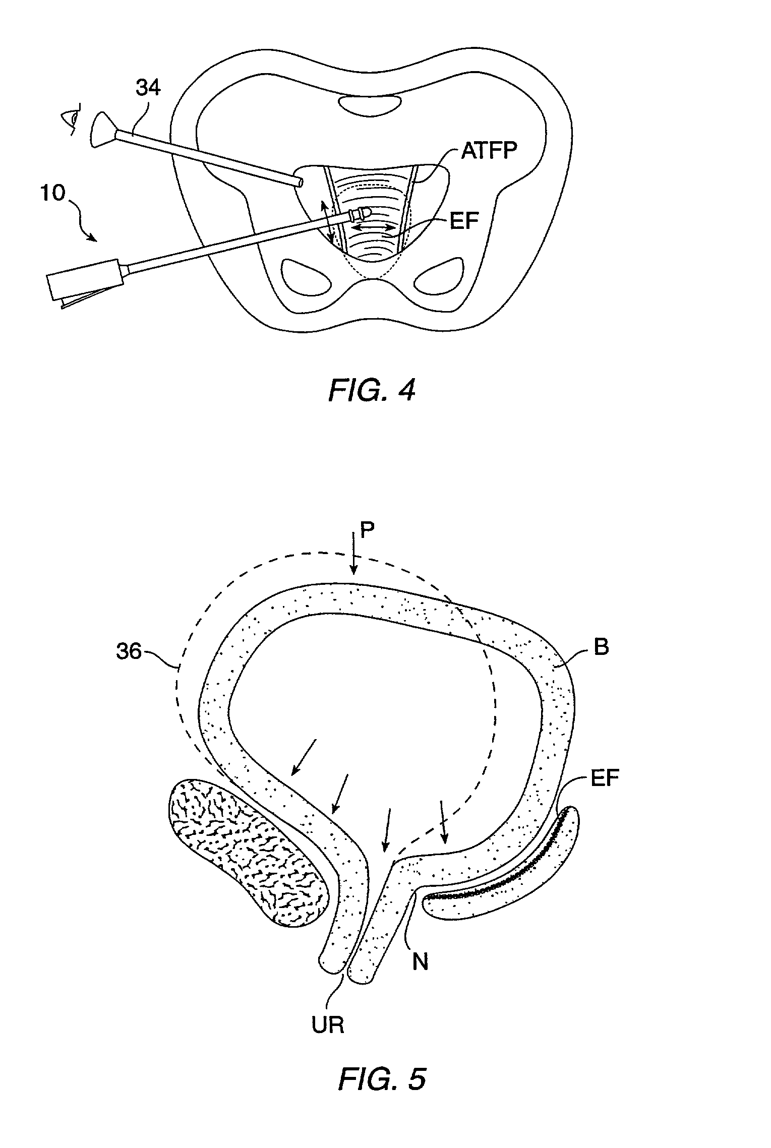 Devices, methods, and systems for shrinking tissues