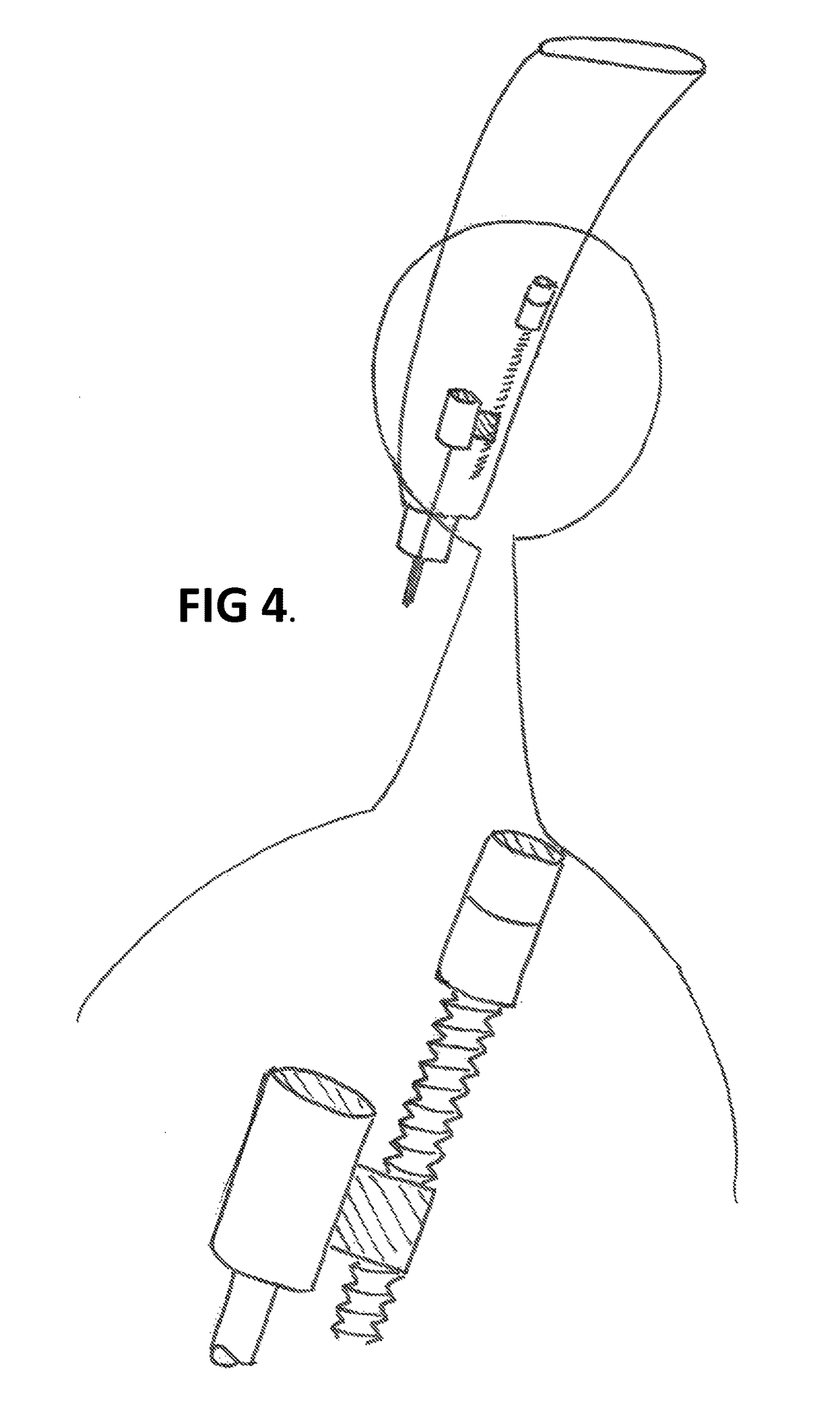Medical device for controlled nail penetration