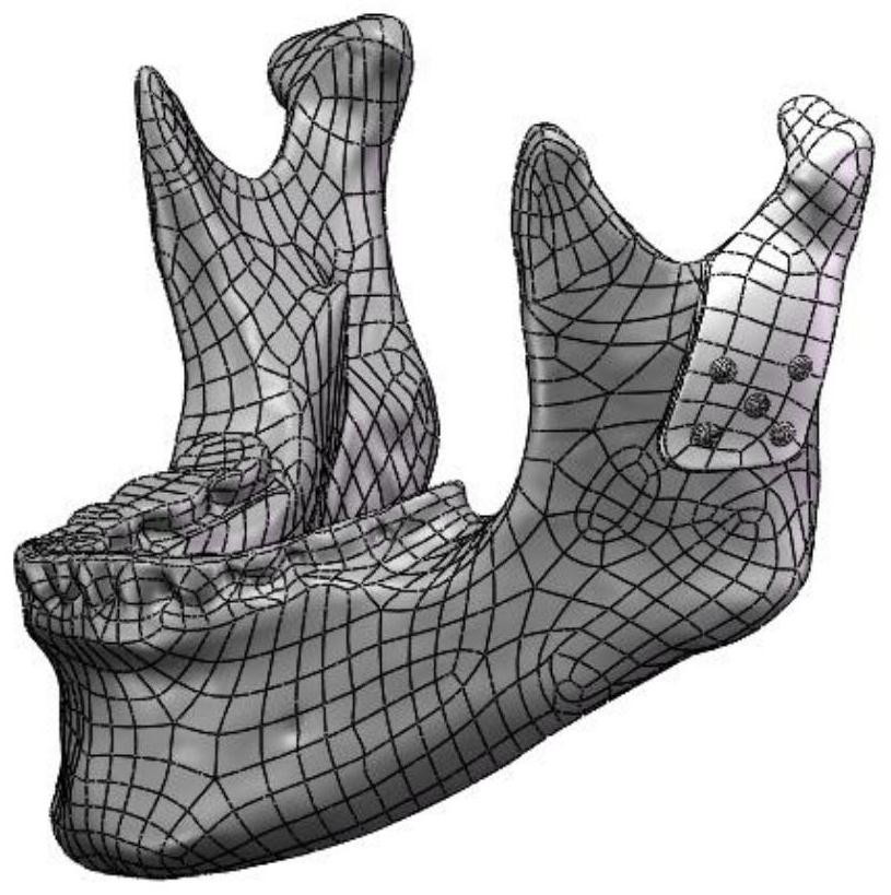 A Design Method of Personalized Condylar Prosthesis