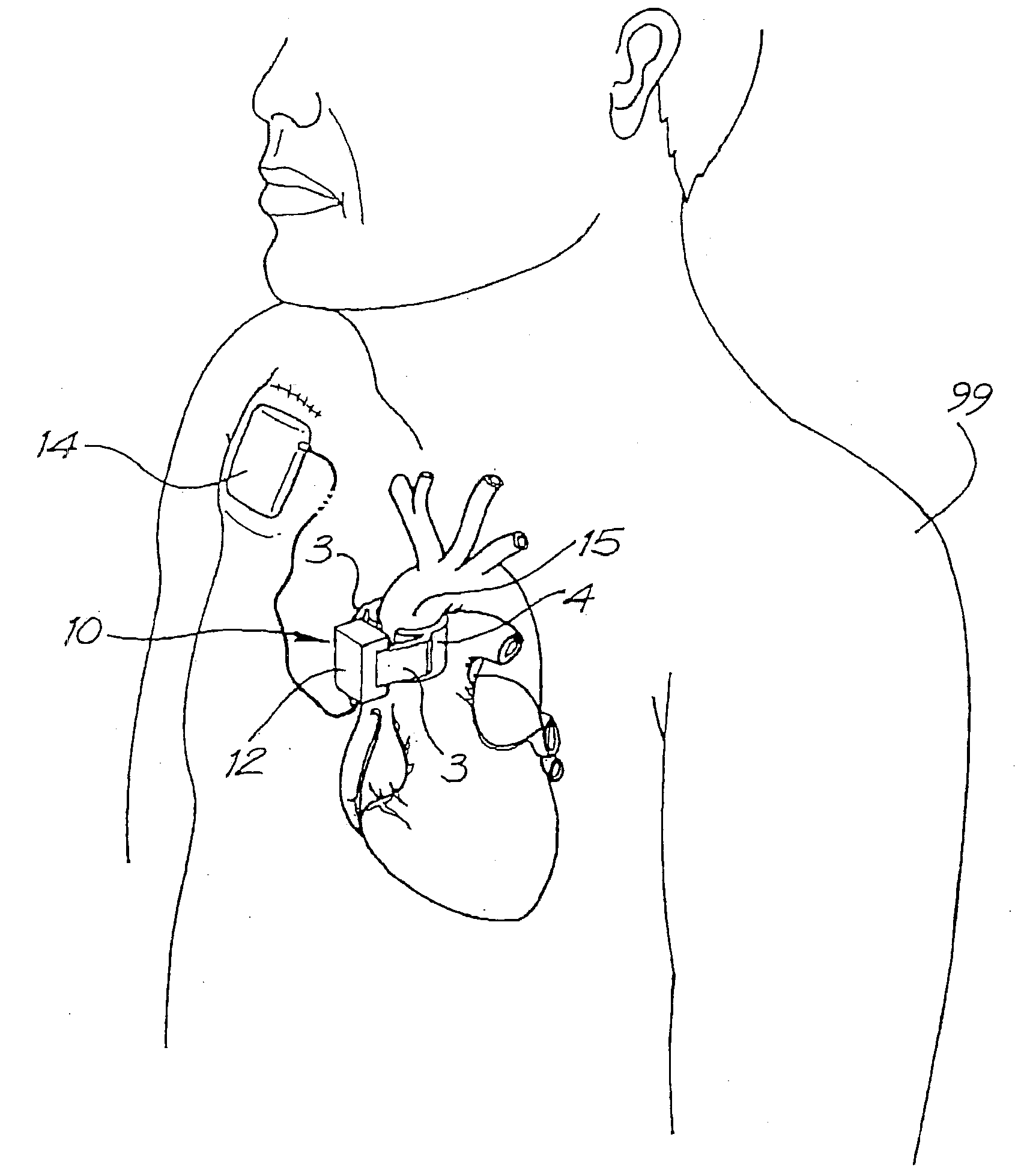 Heart Assist Devices, Systems and Methods